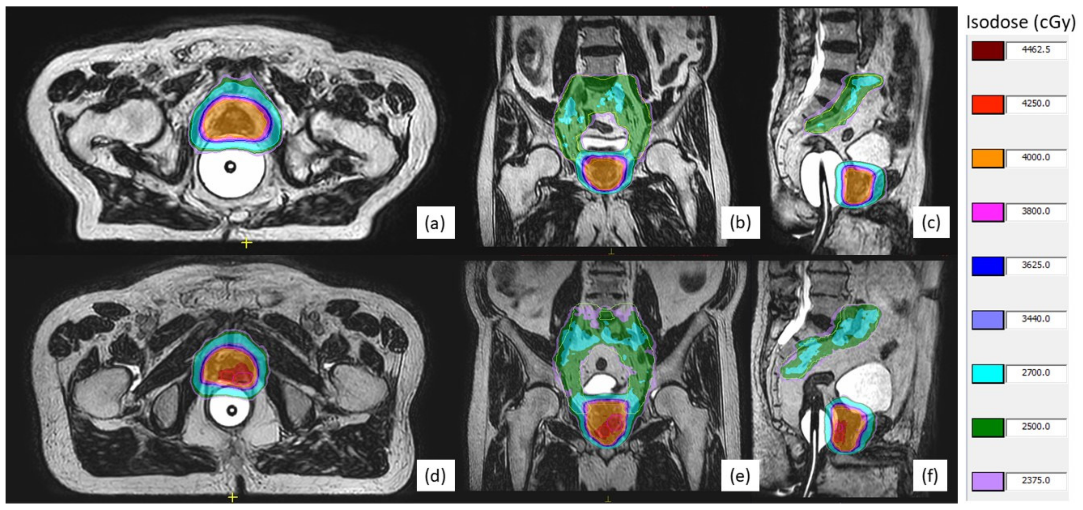 Cancers | Free Full-Text | A Prospective Study of Stereotactic Body  Radiotherapy (SBRT) with Concomitant Whole-Pelvic Radiotherapy (WPRT) for  High-Risk Localized Prostate Cancer Patients Using 1.5 Tesla Magnetic  Resonance Guidance: The Preliminary