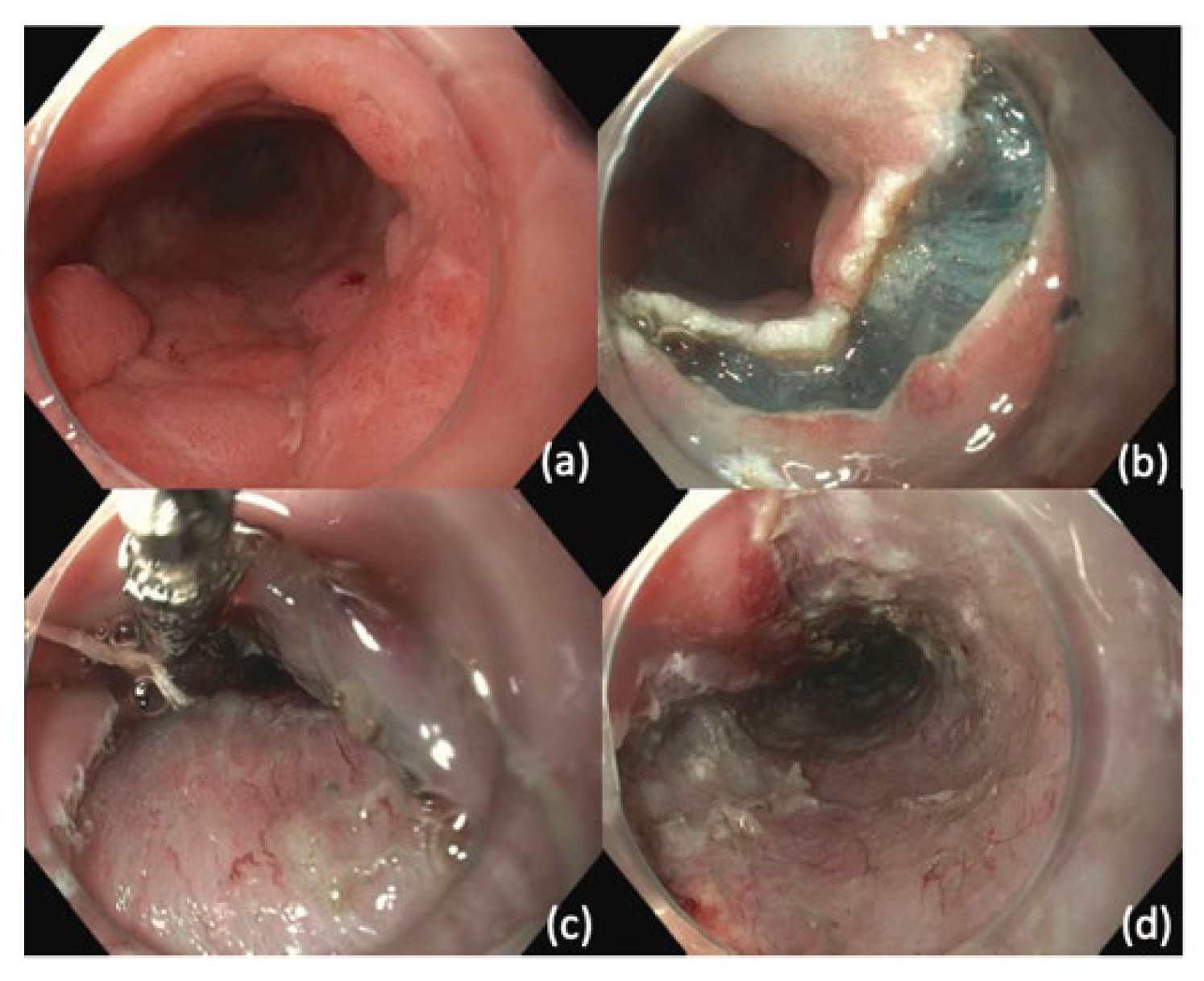 esophagus cancer endoscopy