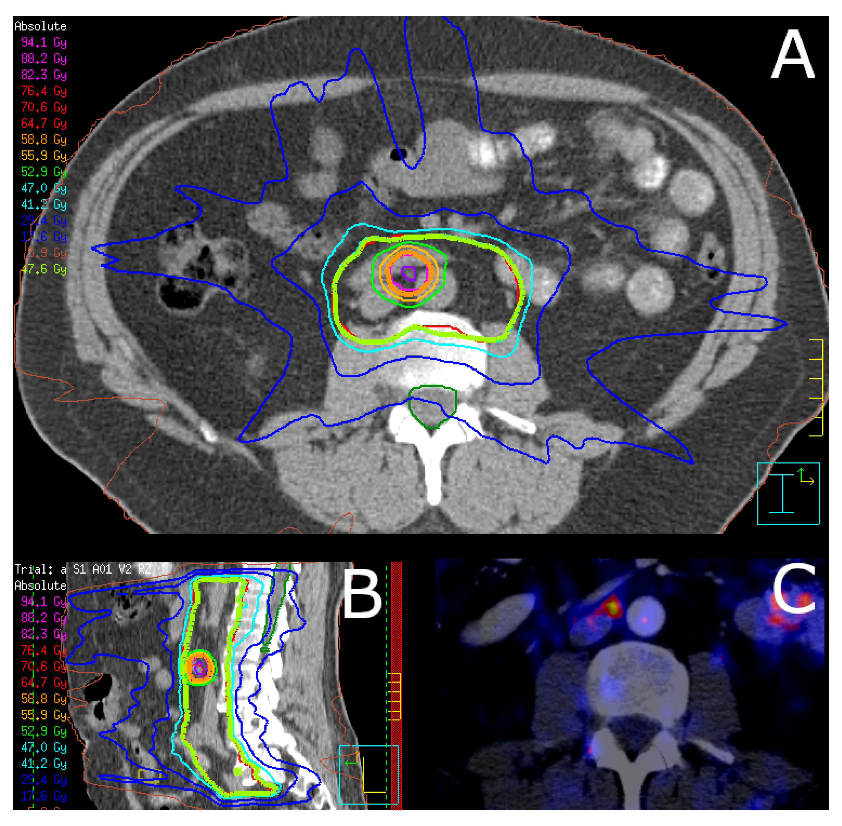 Cancers Free Full Text Salvage Nodal Radiotherapy As Metastasis Directed Therapy For 9861