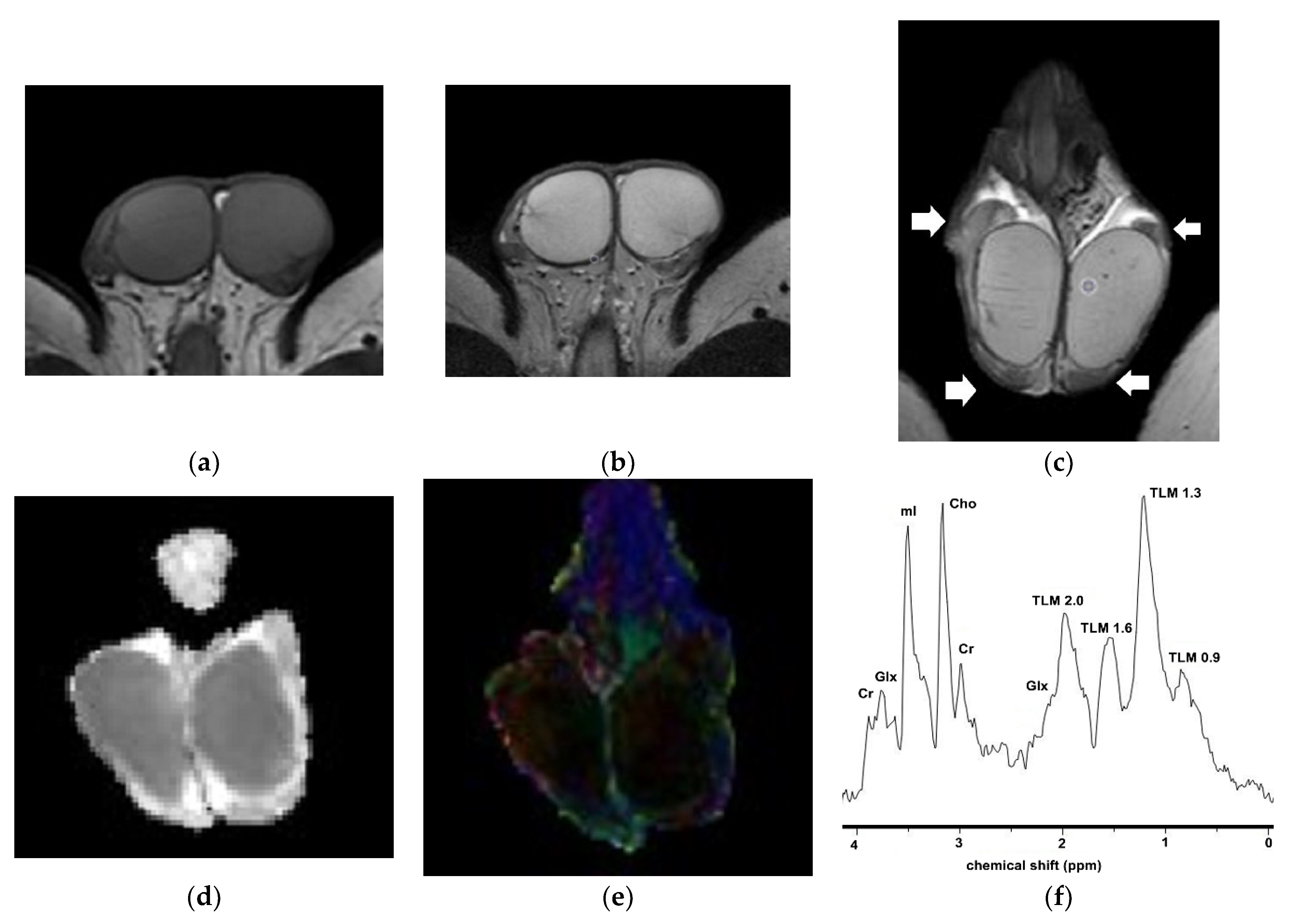 MRI-derived LV parameters of the study group in comparison to normal