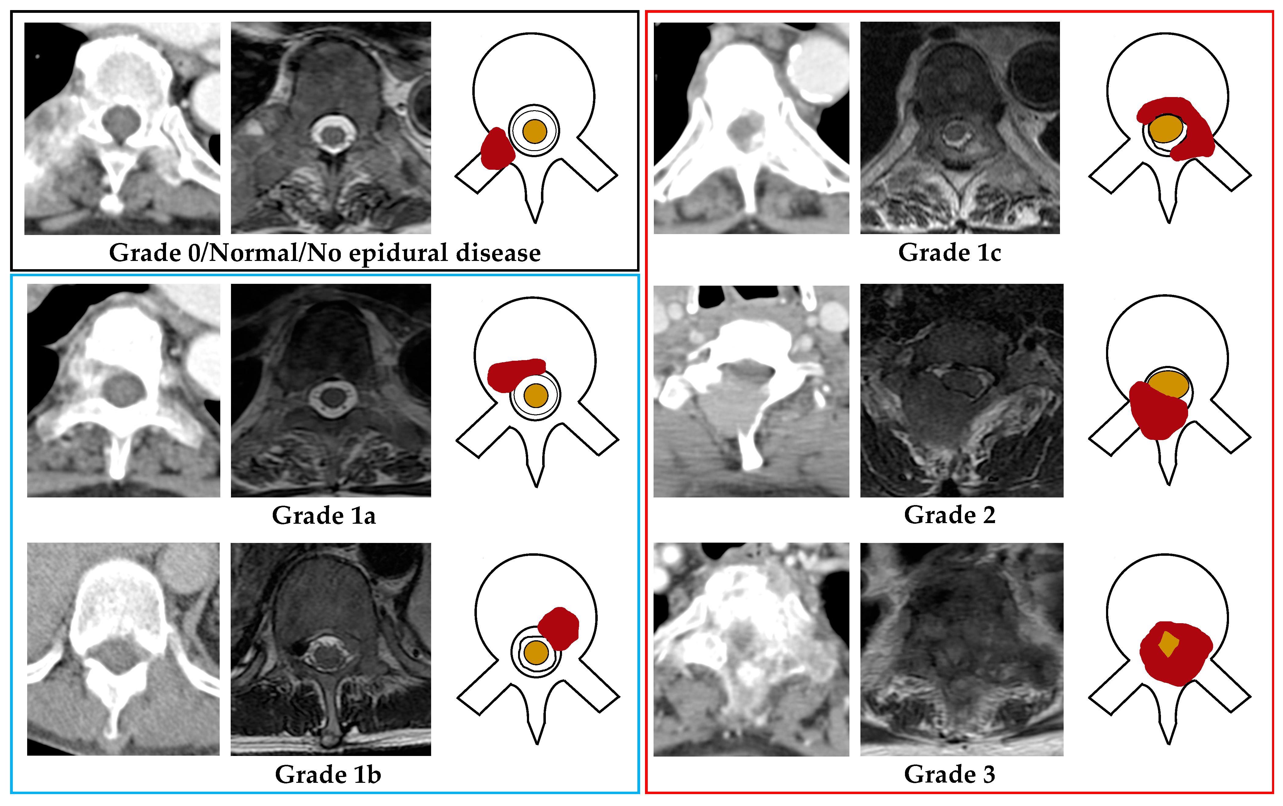Cancers | Free Full-Text | Diagnostic Accuracy of CT for Metastatic  Epidural Spinal Cord Compression