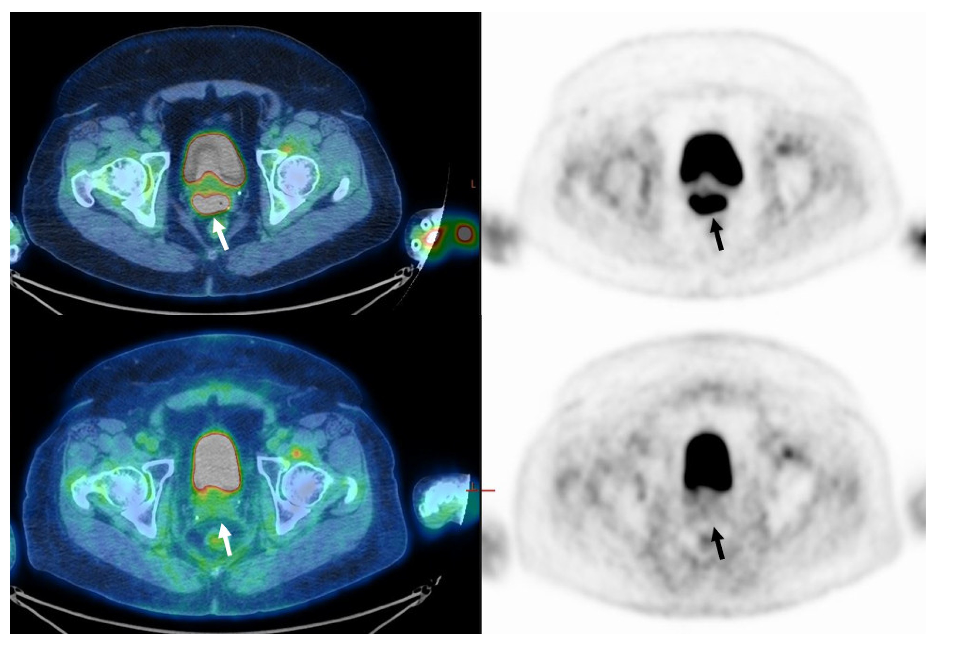 Cancers | Free Full-Text | [F18]FDG PET/CT-Derived Metabolic and Volumetric  Biomarkers Can Predict Response to Treatment in Locally Advanced Cervical  Cancer Patients | HTML