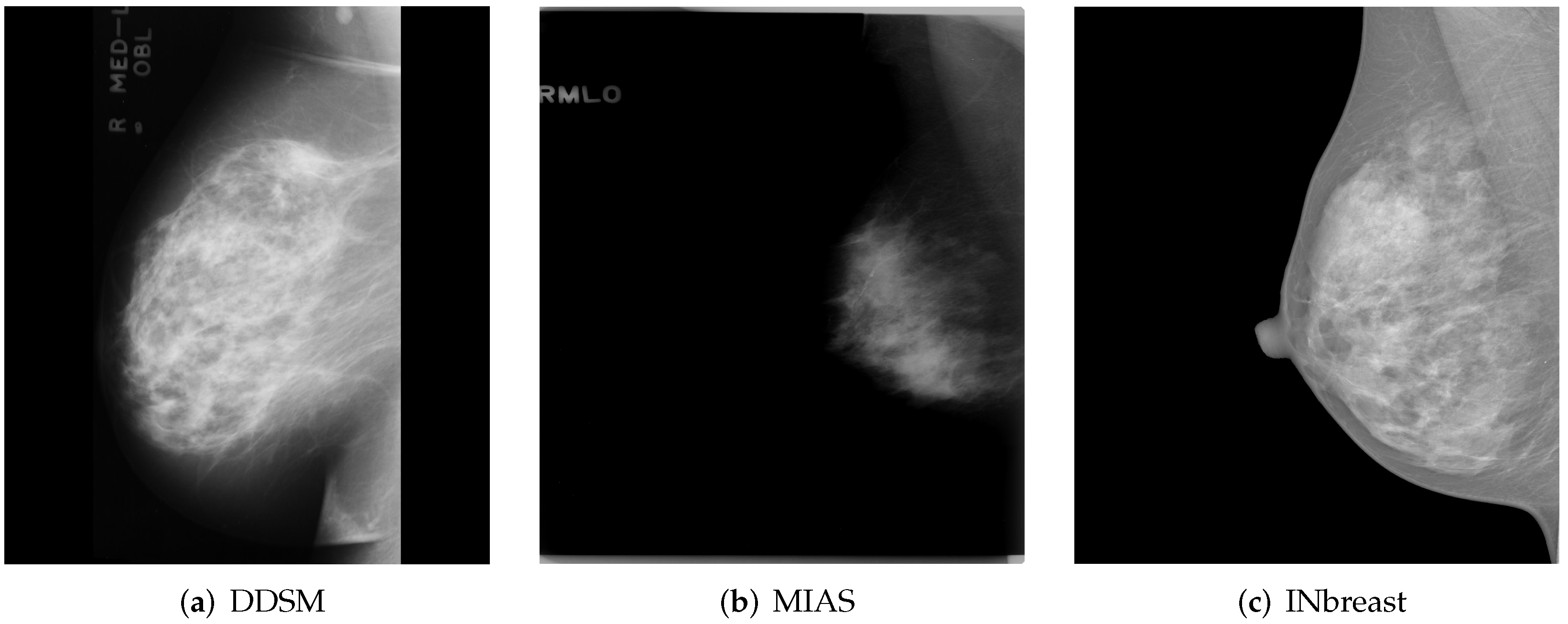 Does Breast Thermo-Imaging Succeed Where Mammograms Fail In The