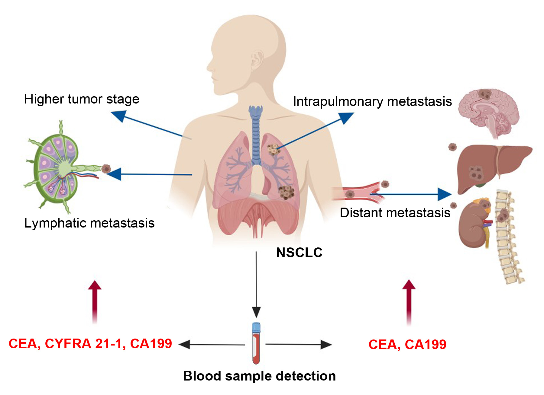 Cancers | Free Full-Text | The Indicative Value of Serum Tumor Markers for  Metastasis and Stage of Non-Small Cell Lung Cancer