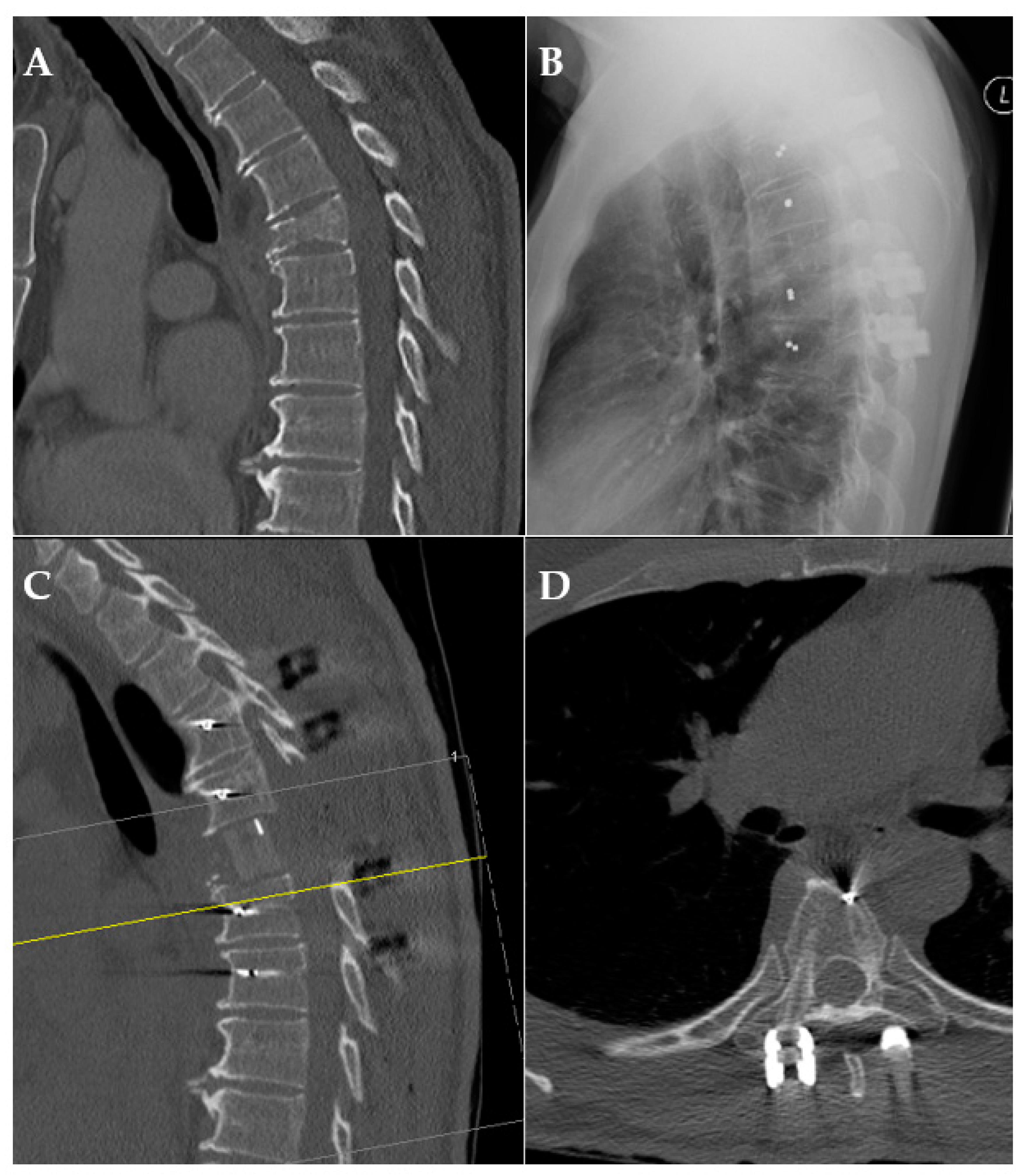 Cancers Free Full Text Cfr Peek Pedicle Screw Instrumentation For Spinal Neoplasms A Single