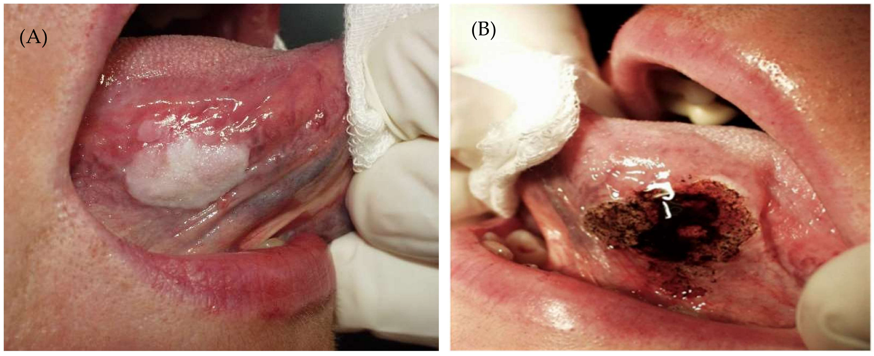Cancers | Free Full-Text | Recurrence of Oral Leukoplakia after CO2 Laser  Resection: A Prospective Longitudinal Study