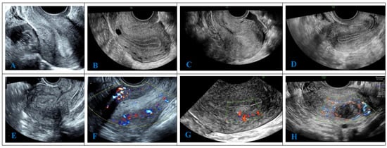 Cancers | Free Full-Text | IETA Ultrasonic Features Combined with GI ...