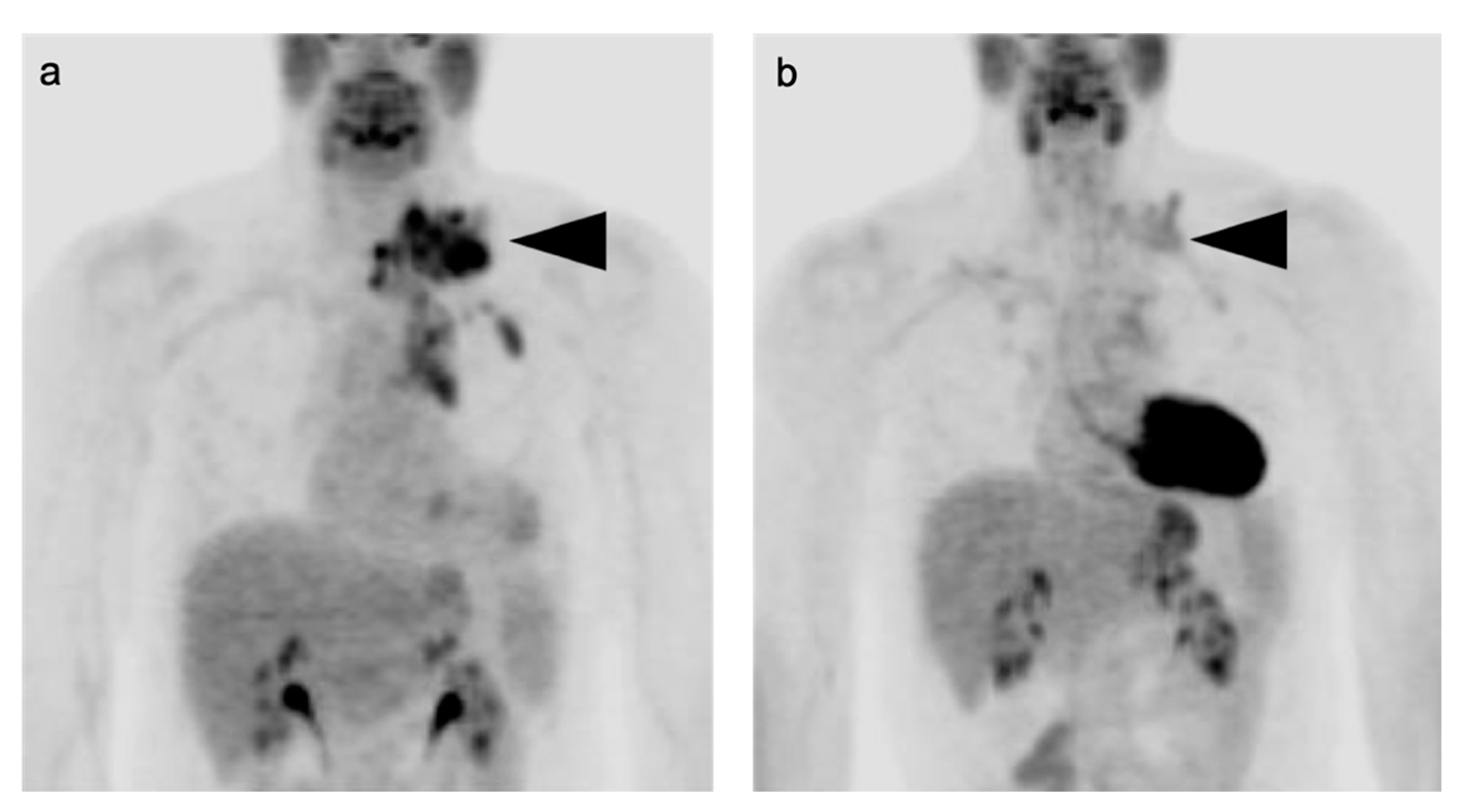 Cancers | Free Full-Text | PET-CT in Clinical Adult Oncology: I.  Hematologic Malignancies