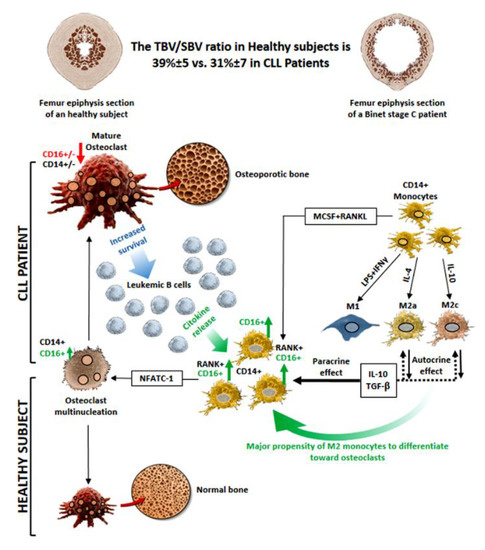 Cancers | Free Full-Text | A High Percentage of CD16+ Monocytes