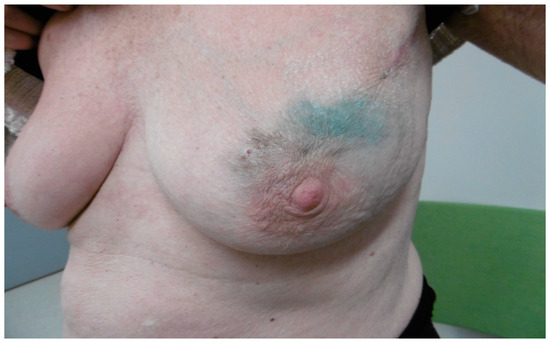 Bravo Post-Mastectomy Breast Form at