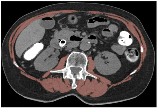 Impact of Sarcopenia on Outcomes Following Resection of Pancreatic  Adenocarcinoma