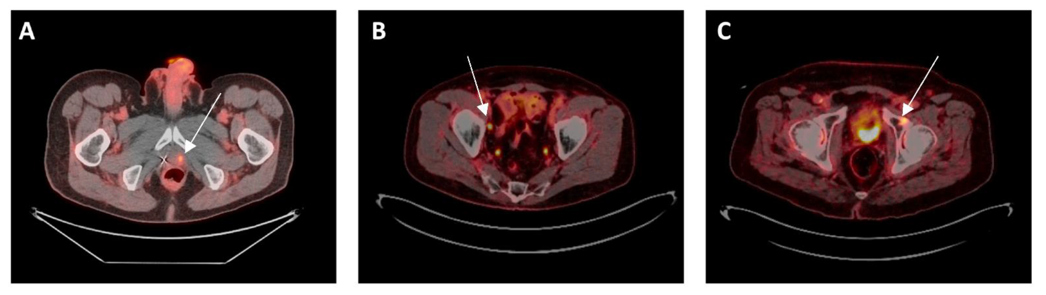 18F-fluciclovine-PET/CT imaging versus conventional imaging alone to guide  postprostatectomy salvage radiotherapy for prostate cancer (EMPIRE-1): a  single centre, open-label, phase 2/3 randomised controlled trial - The  Lancet