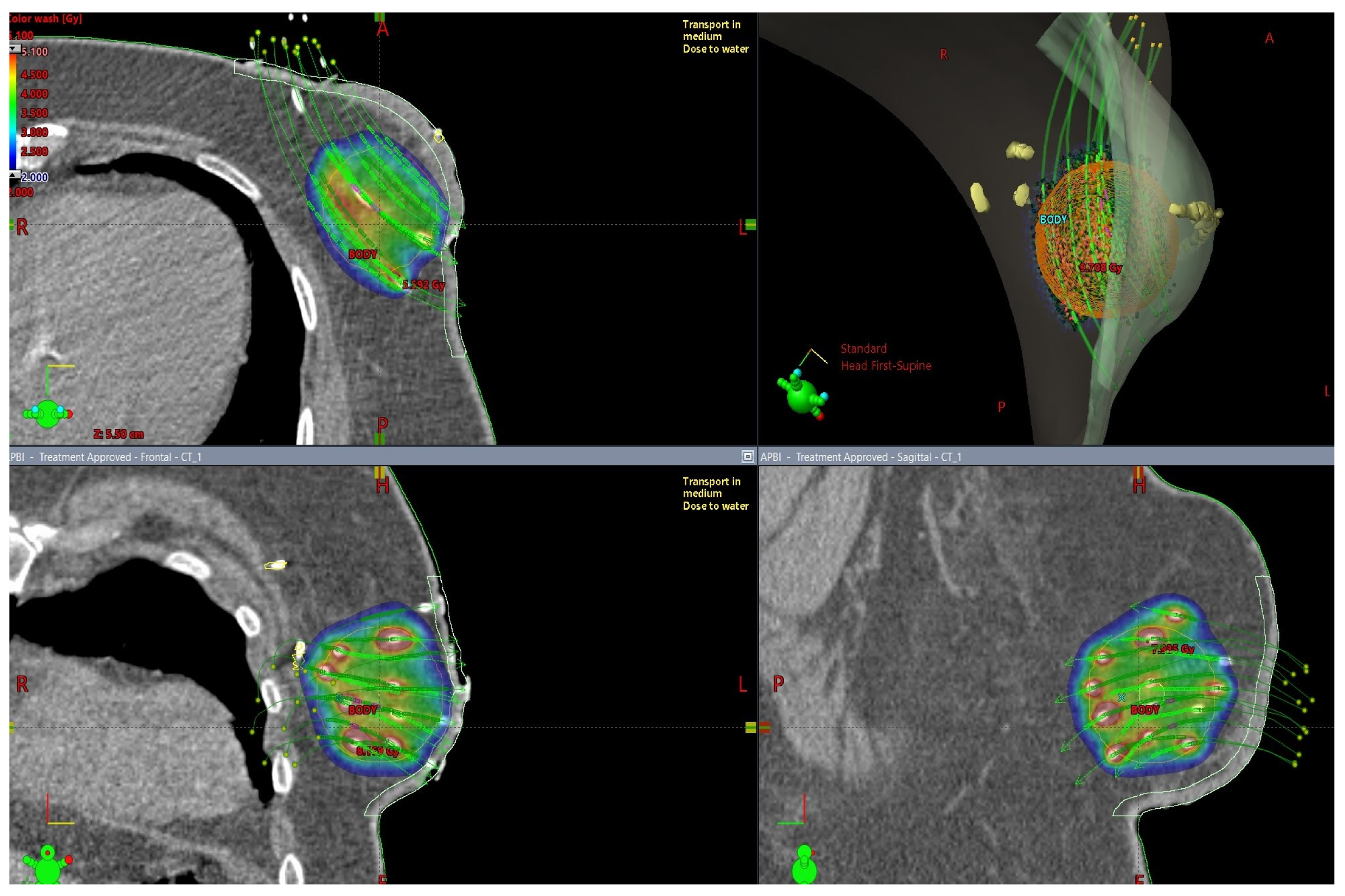 European Society for Radiotherapy and Oncology Advisory Committee in  Radiation Oncology Practice consensus recommendations on patient selection  and dose and fractionation for external beam radiotherapy in early breast  cancer - The Lancet