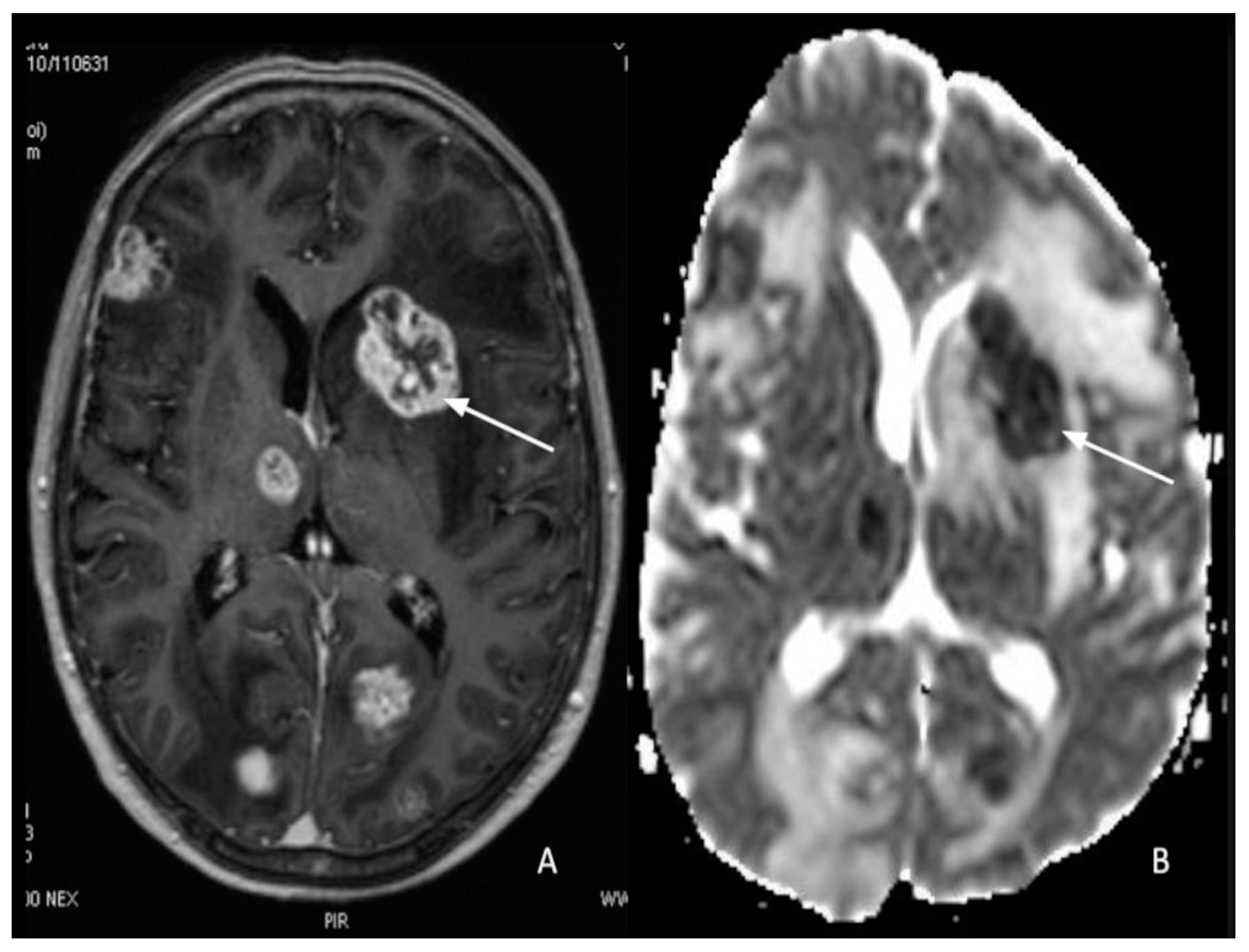 kif20a-as-a-potential-biomarker-of-renal-and-bladder-cancers-based-on