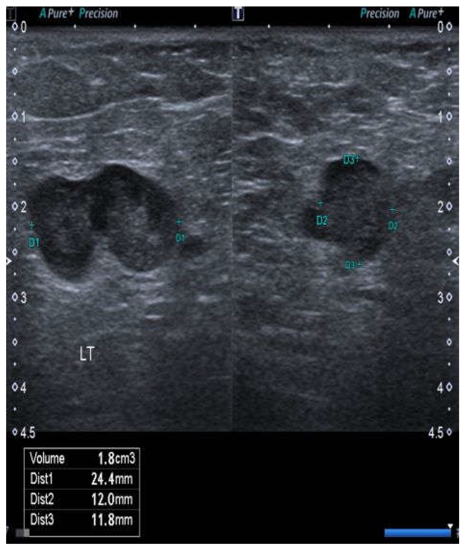 groin lymph nodes ultrasound