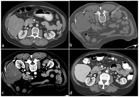 Cancers Free Full Text Outcomes Of Radiofrequency Ablation For Solitary T1a Renal Cell