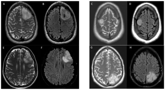 Cancers | Free Full-Text | Multi-Parametric Radiomic Model to Predict ...