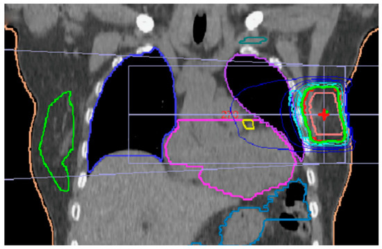 European Society for Radiotherapy and Oncology Advisory Committee in  Radiation Oncology Practice consensus recommendations on patient selection  and dose and fractionation for external beam radiotherapy in early breast  cancer - The Lancet