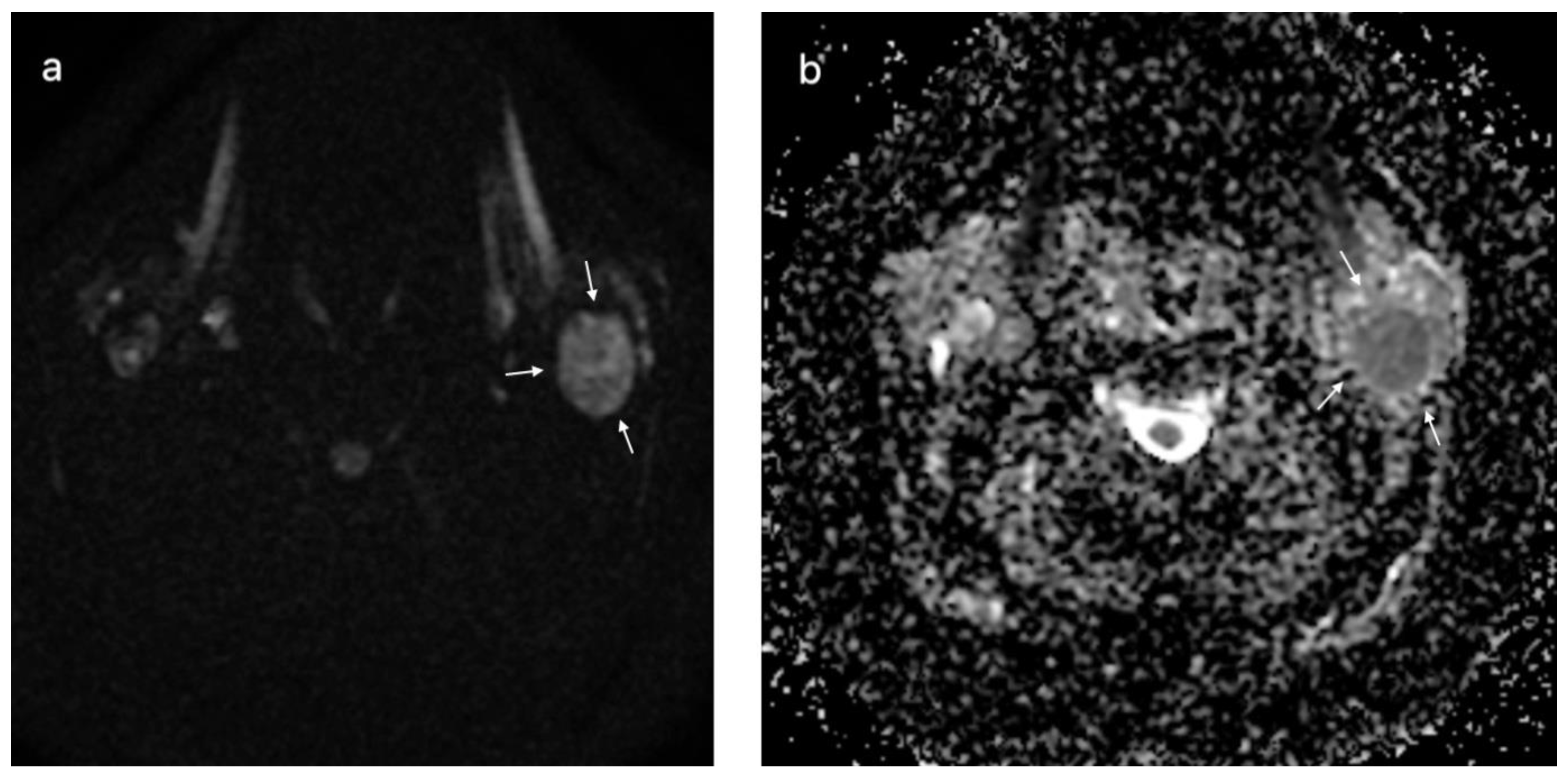 Cureus, Sequelae of a Rare Case of Penetrating Parotid Gland Injury:  Ultrasound and Magnetic Resonance Imaging Features