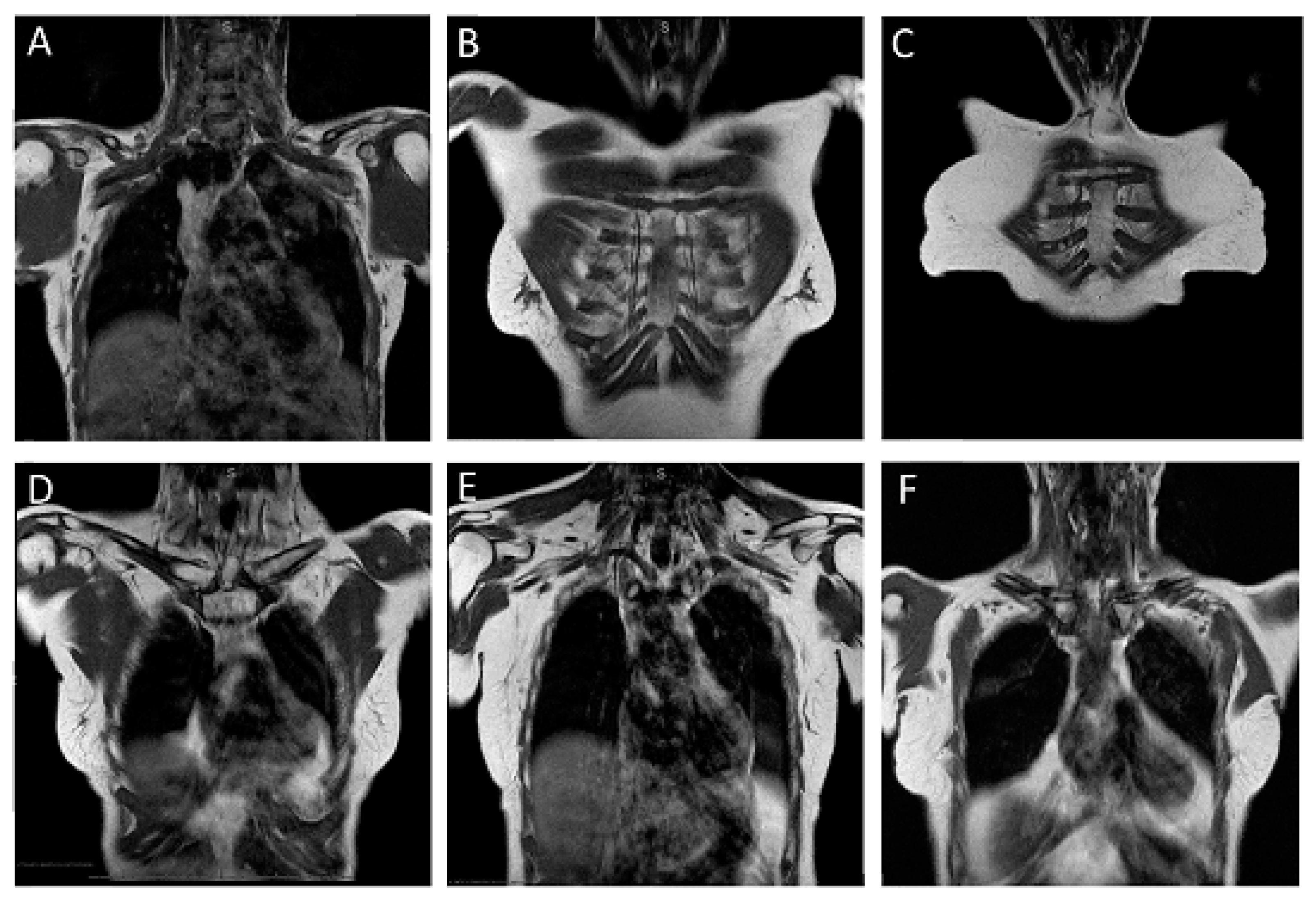 Cancers Free Full Text Abbreviated Mri For Comprehensive Regional Lymph Node Staging During 