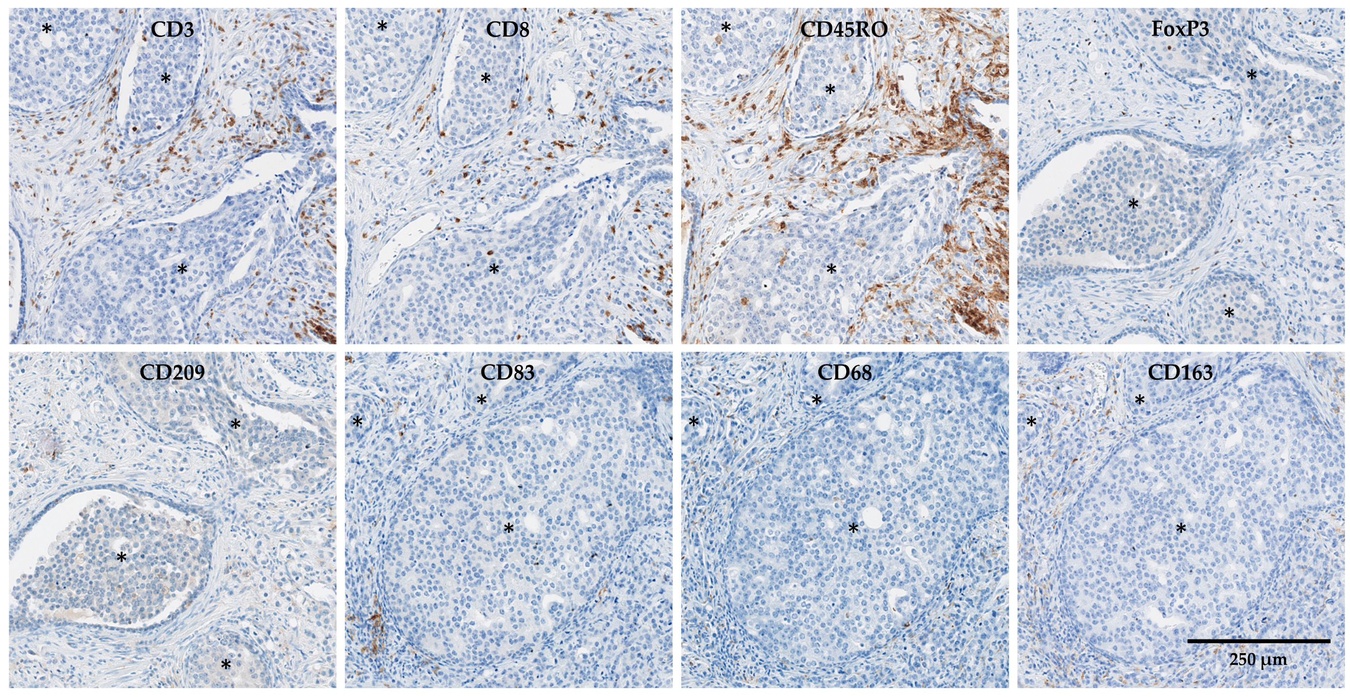 Macrophage cell counts (cells per mm2) in biopsy and tumour resection
