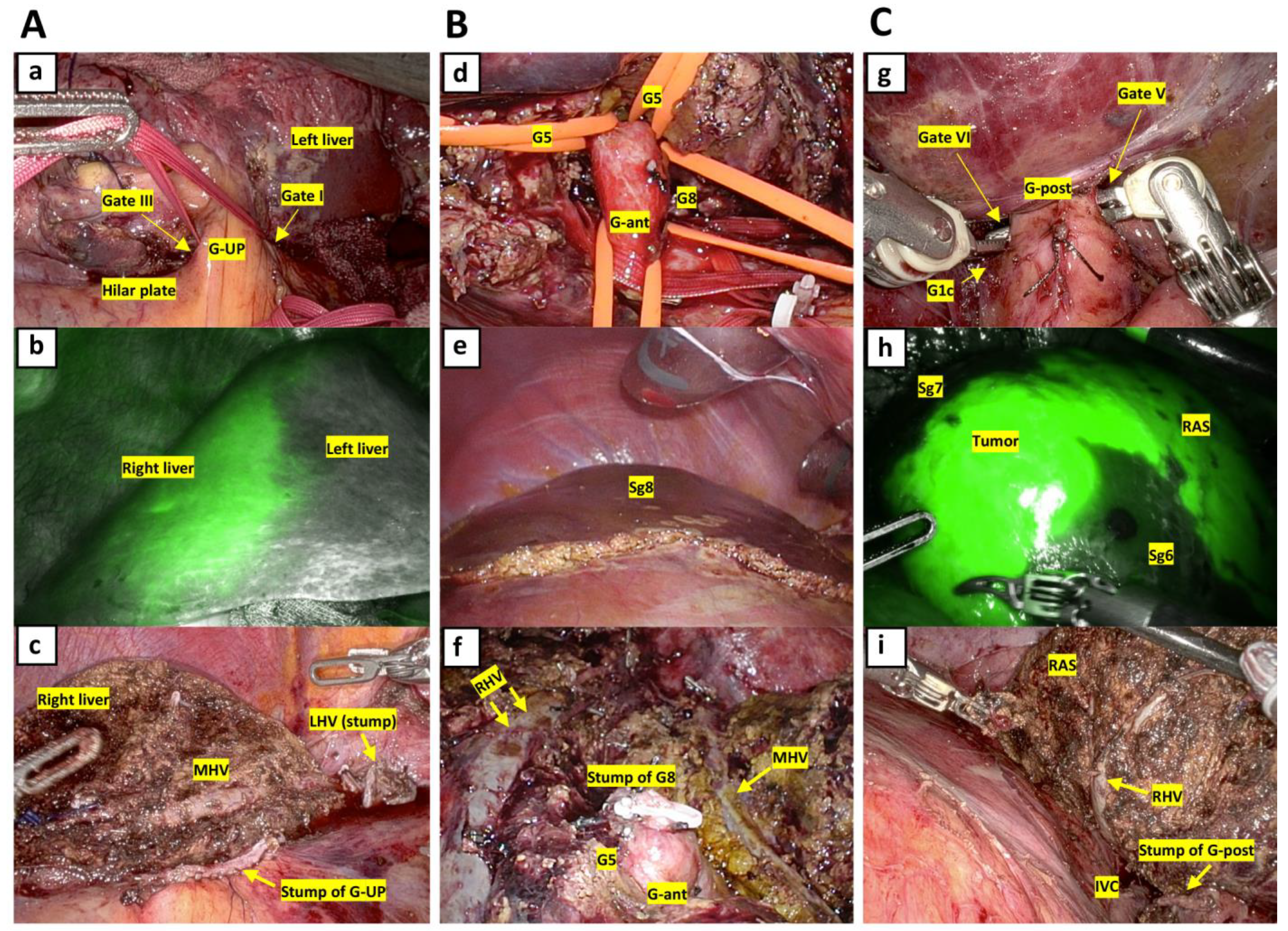 Cancers | Free Full-Text | Minimally Invasive Anatomic Liver Resection for  Hepatocellular Carcinoma Using the Extrahepatic Glissonian Approach:  Surgical Techniques and Comparison of Outcomes with the Open Approach and  between the Laparoscopic