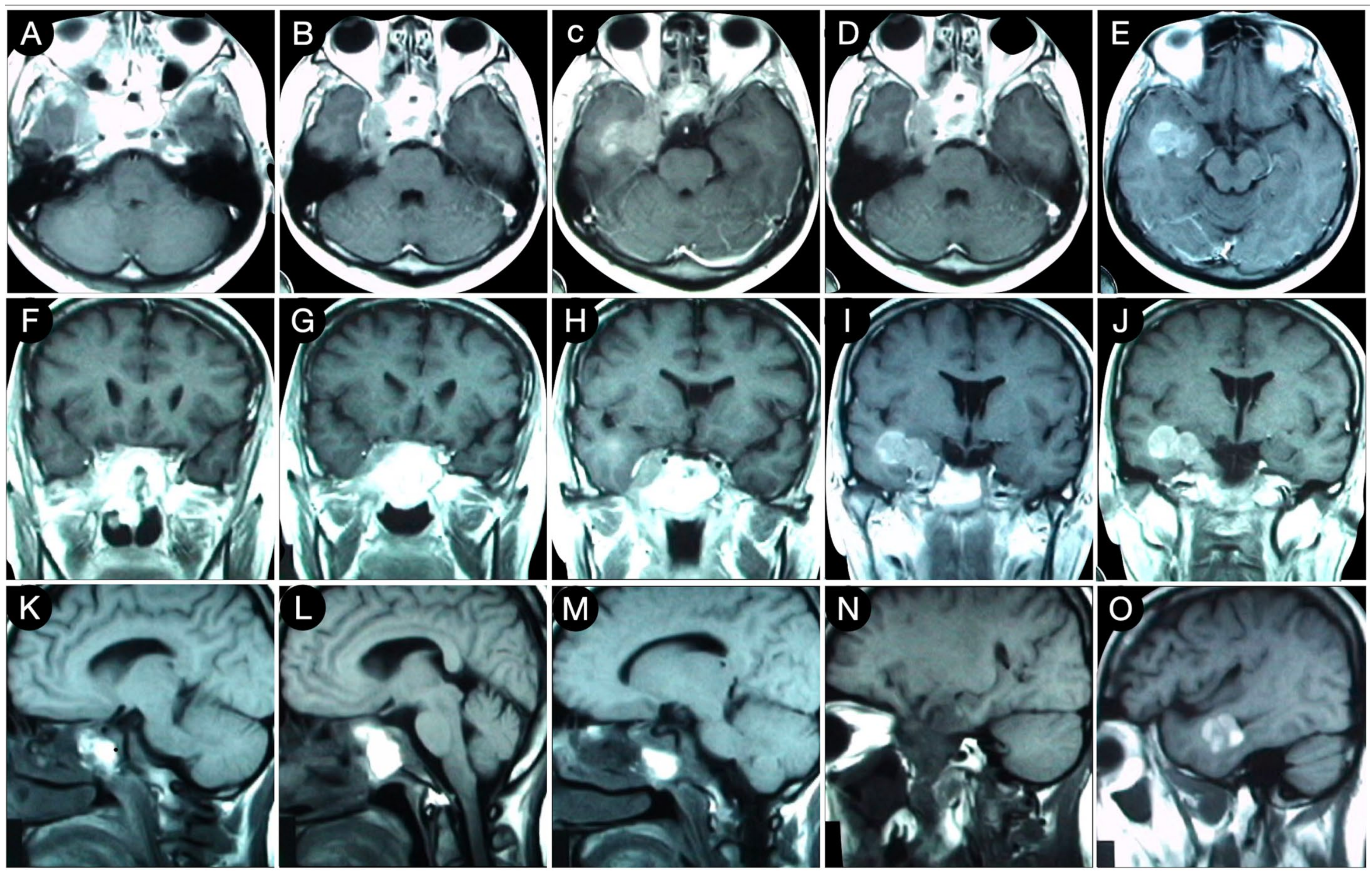 Cancers | Free Full-Text | The Party Wall: Redefining the Indications of  Transcranial Approaches for Giant Pituitary Adenomas in Endoscopic Era