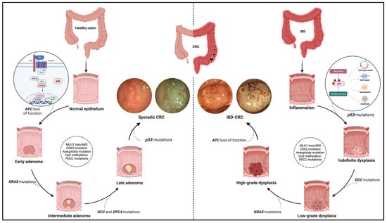 Cancers | Free Full-Text | Inflammation-Driven Colorectal Cancer ...