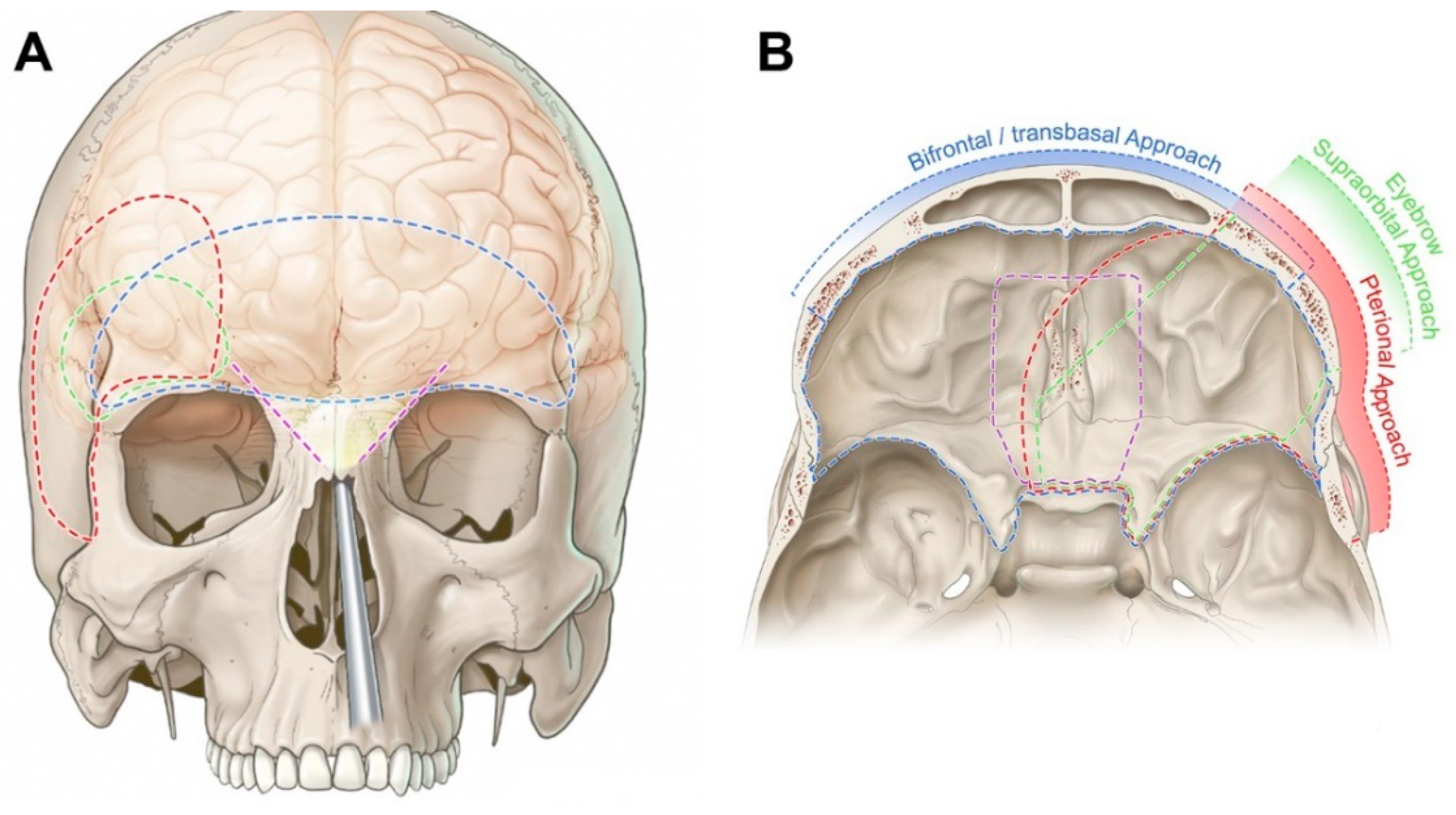 Figure From Surgical Treatment Of Anterior Cranial Fossa Dural My Xxx Hot Girl 3034