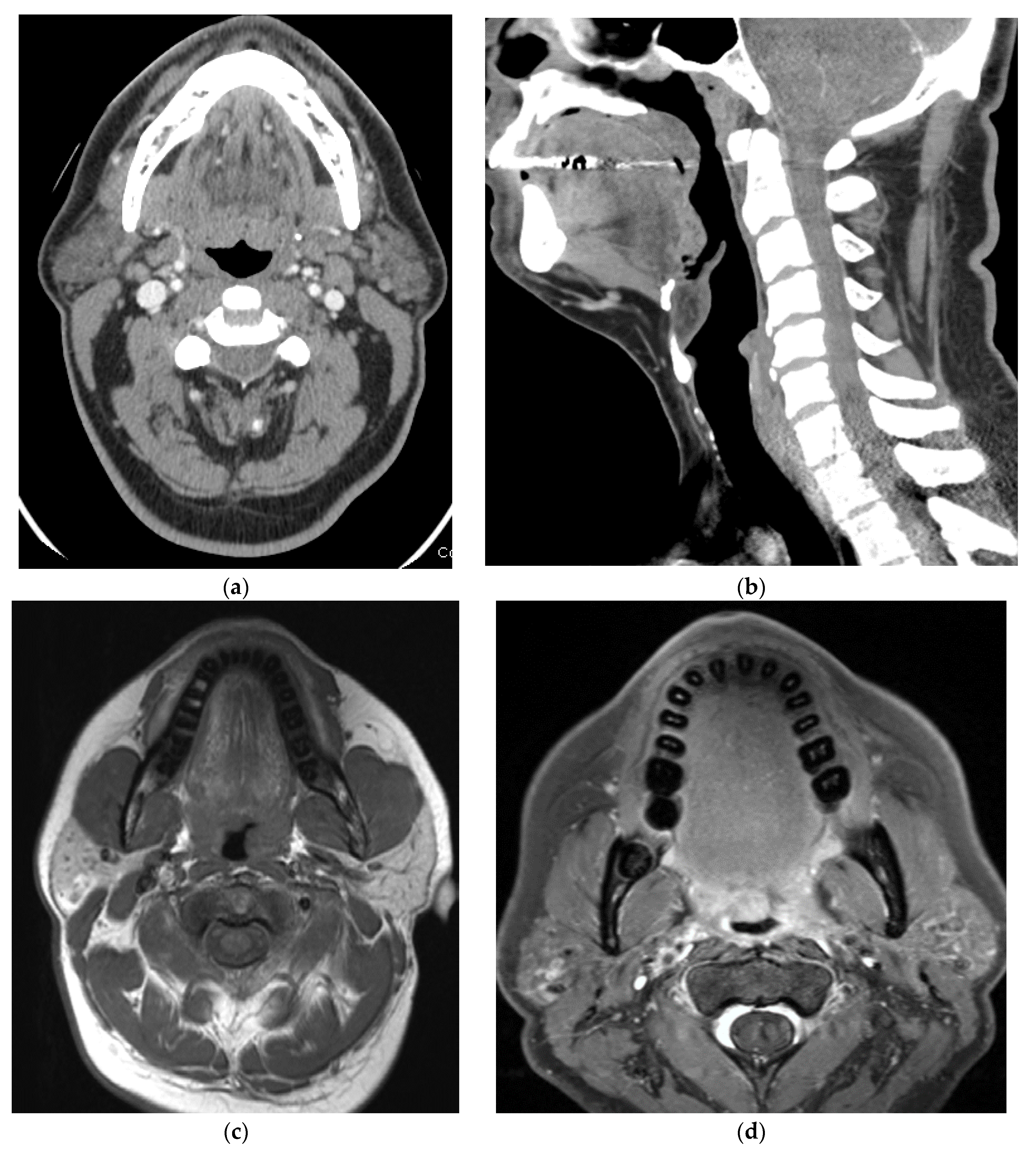 Cancers Free Full-Text Role of PET/CT in Oropharyngeal Cancers
