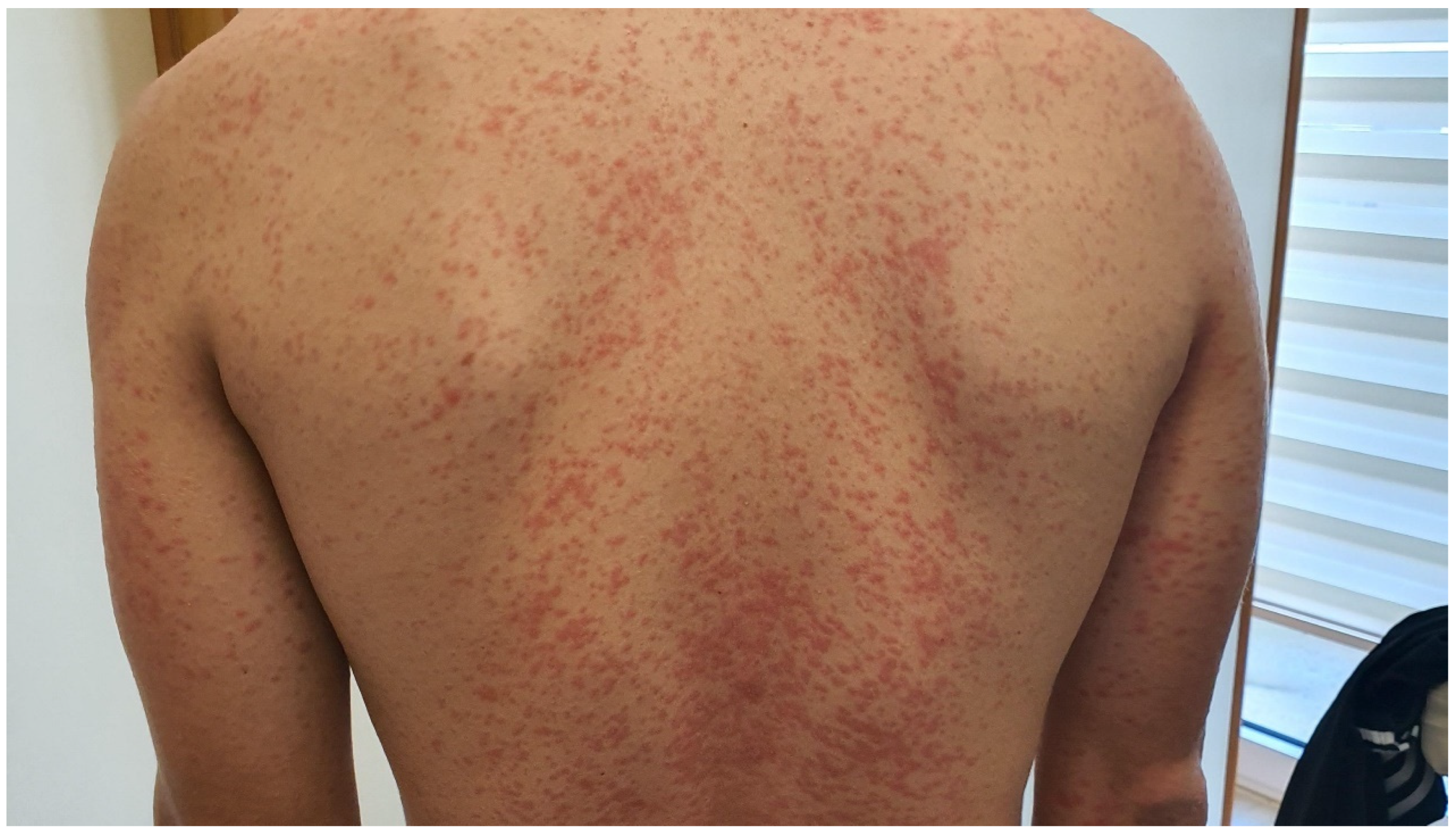 Dermatitis herpetiformis Hals