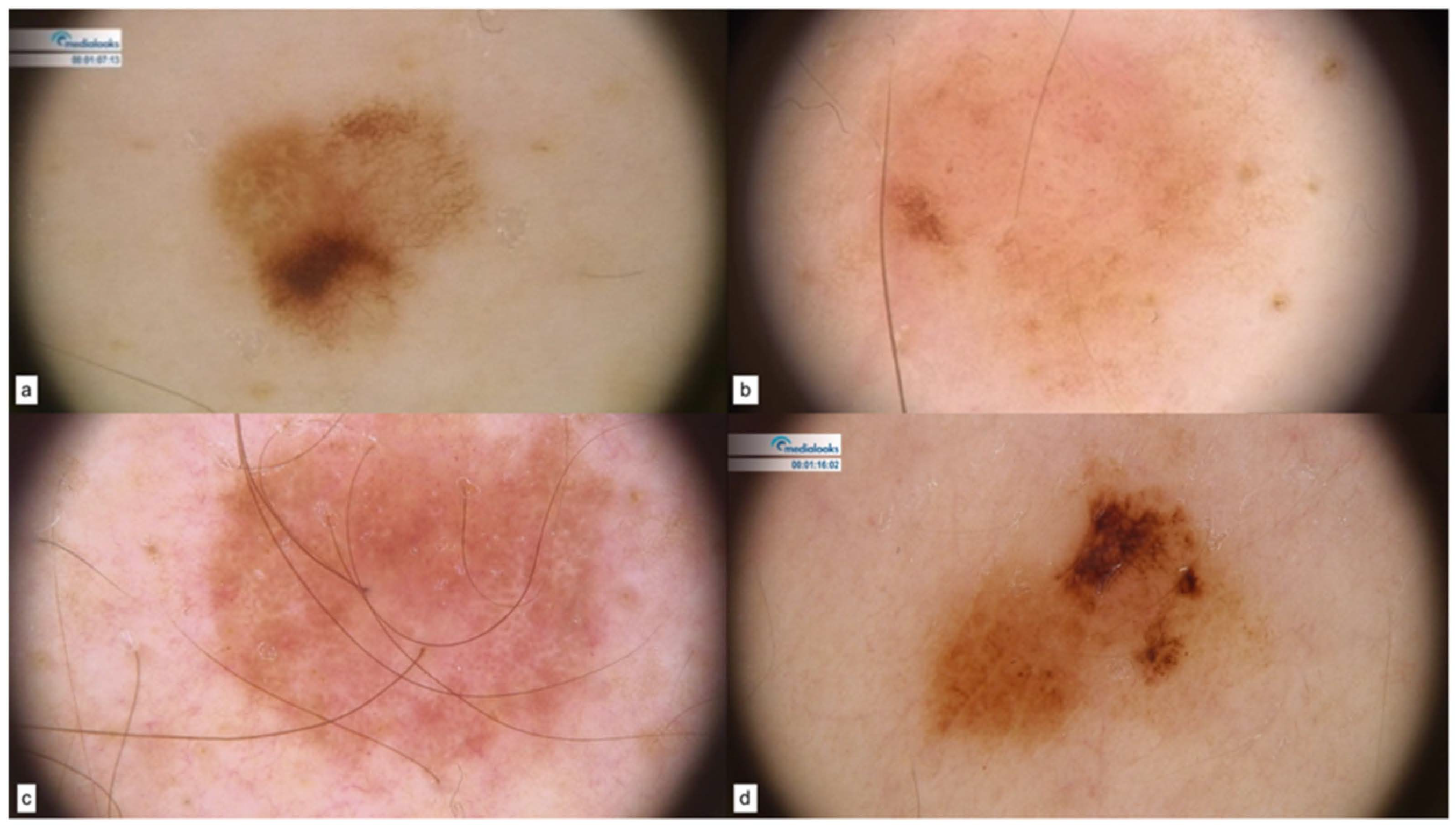 Cancers | Free Full-Text | Phenotypic and Dermoscopic Patterns of