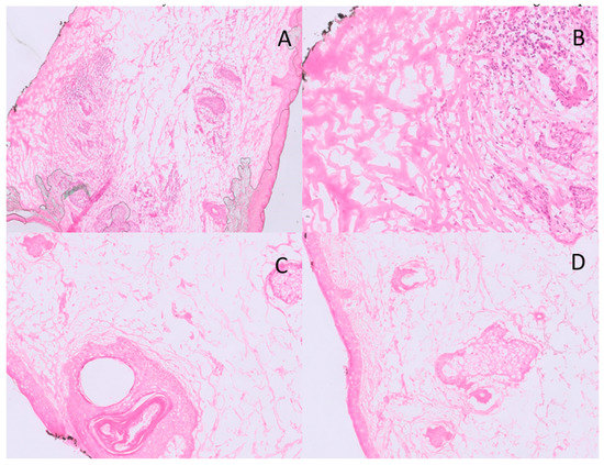 Cancers Free Full Text Recurrence Of Basal Cell Carcinoma Treated With Surgical Excision And