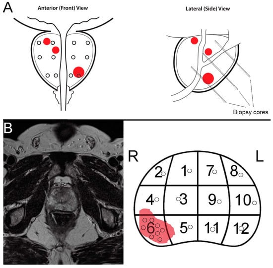 Cancers Free Full Text Mri Guided Targeted And Systematic Prostate Biopsies As Prognostic 4644