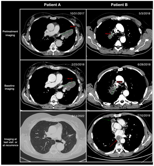 Cancers | Free Full-Text | Pretreatment Tumor Growth Rate and Radiological  Response as Predictive Markers of Pathological Response and Survival in  Patients with Resectable Lung Cancer Treated by Neoadjuvant Treatment