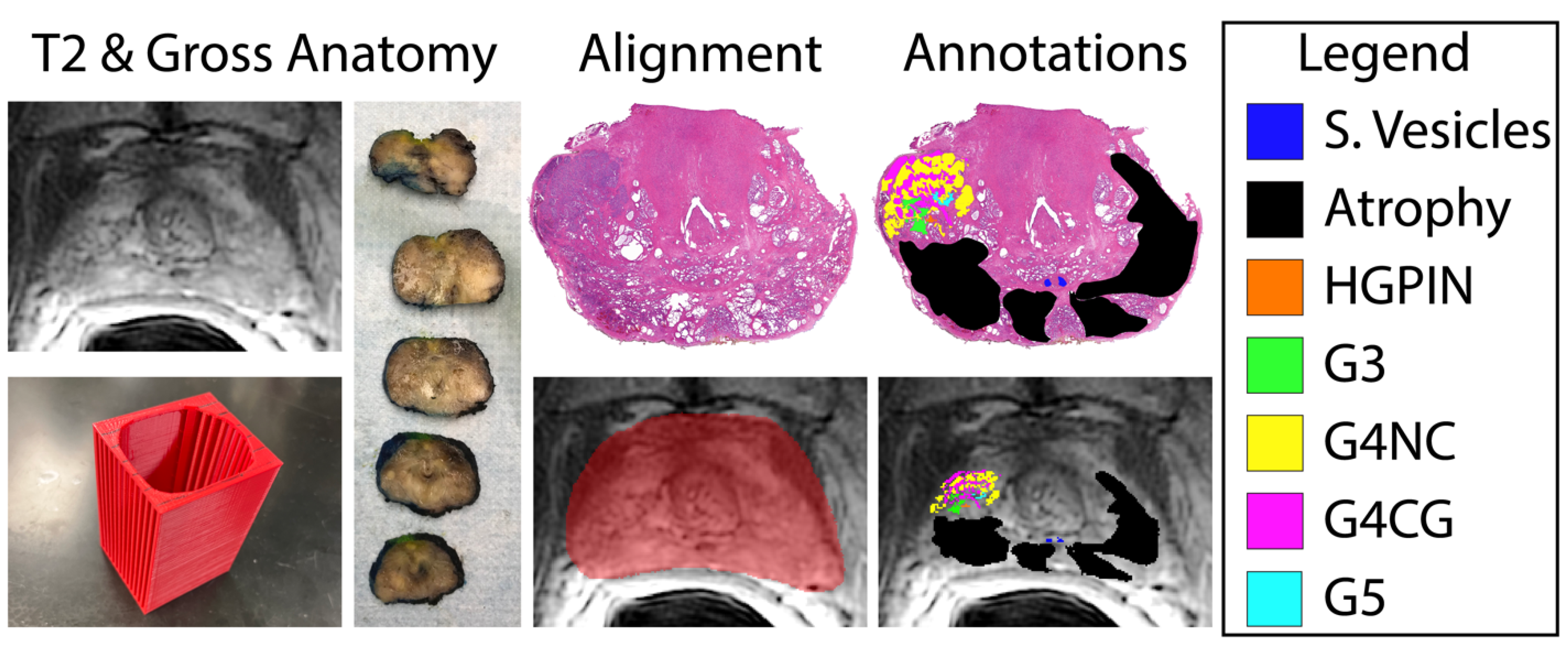 Frontiers  Multiparametric magnetic resonance imaging-derived