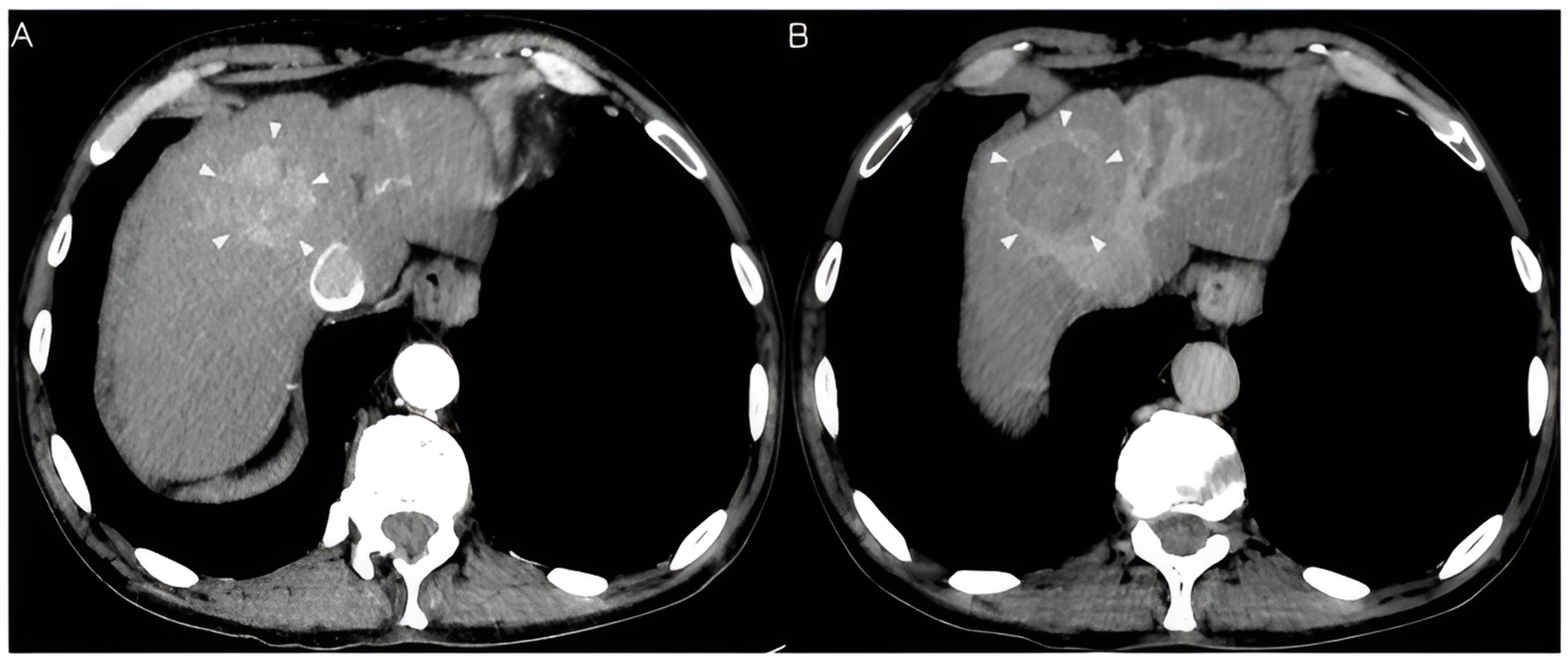 Nar - HB Radiofrequency