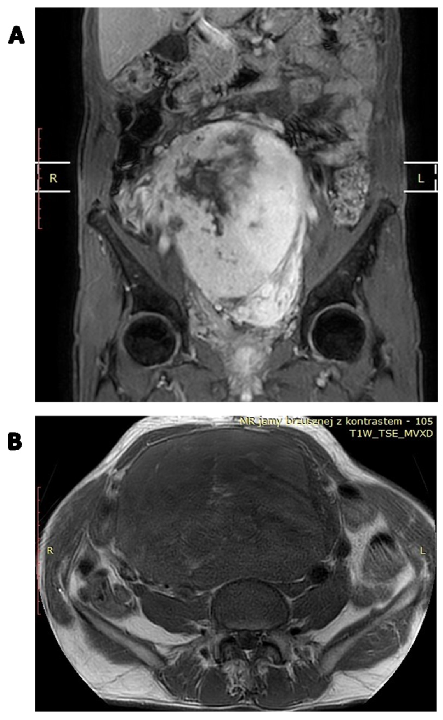 Cancers Free Full Text Diagnostics And Treatment Of Extrameningeal Solitary Fibrous Tumors