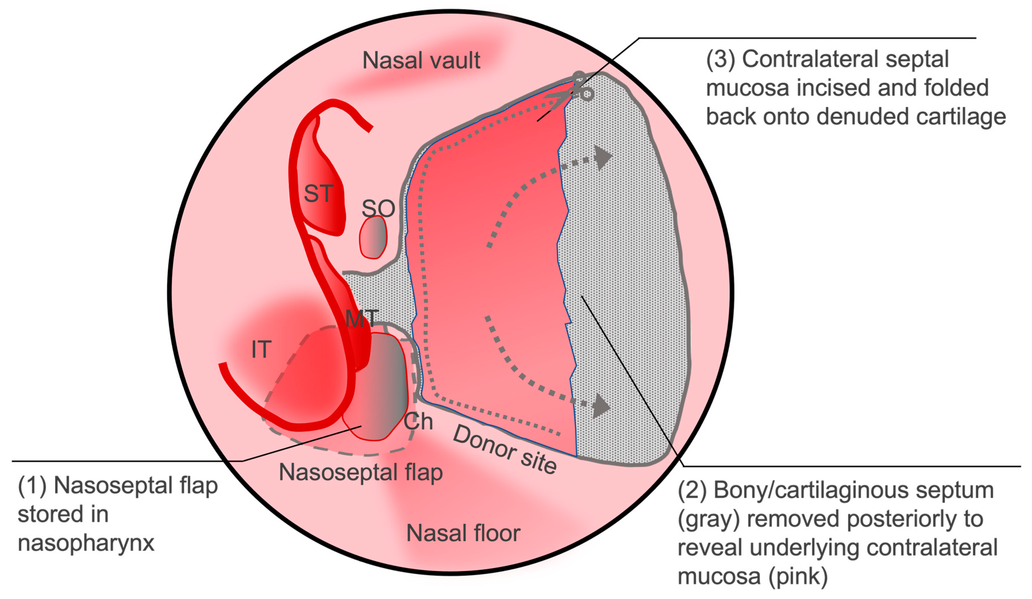 Cancers Free Full Text Reconstruction of the Anterior Skull