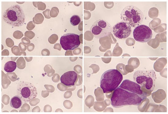 Cancers Free Full Text Hematological Neoplasms with Eosinophilia