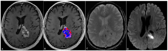 Cancers | Free Full-Text | Advances in Neuro-Oncological Imaging 