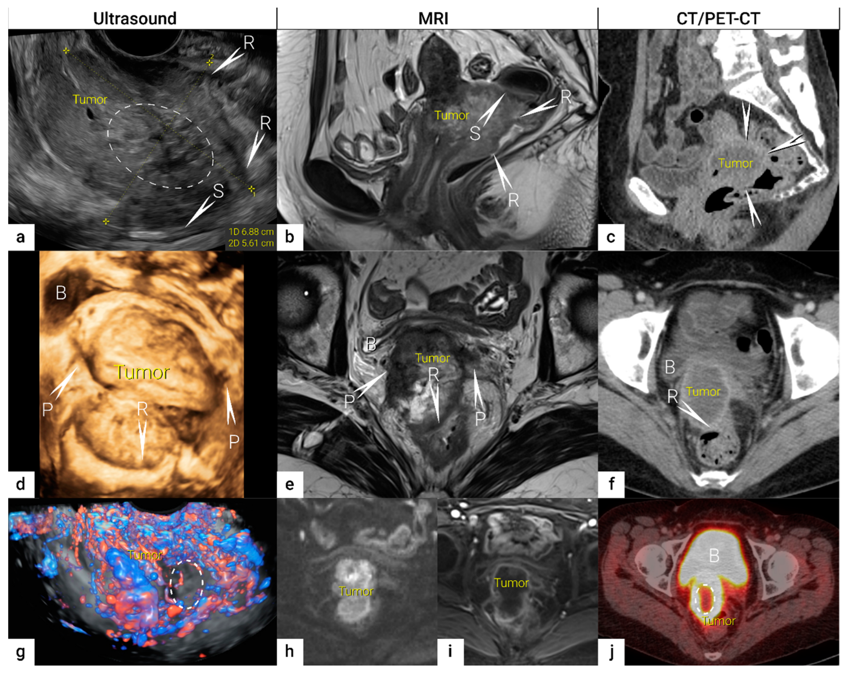 Uterine prolapse. (left) Lateral view of pelvis showing normal pelvic ß