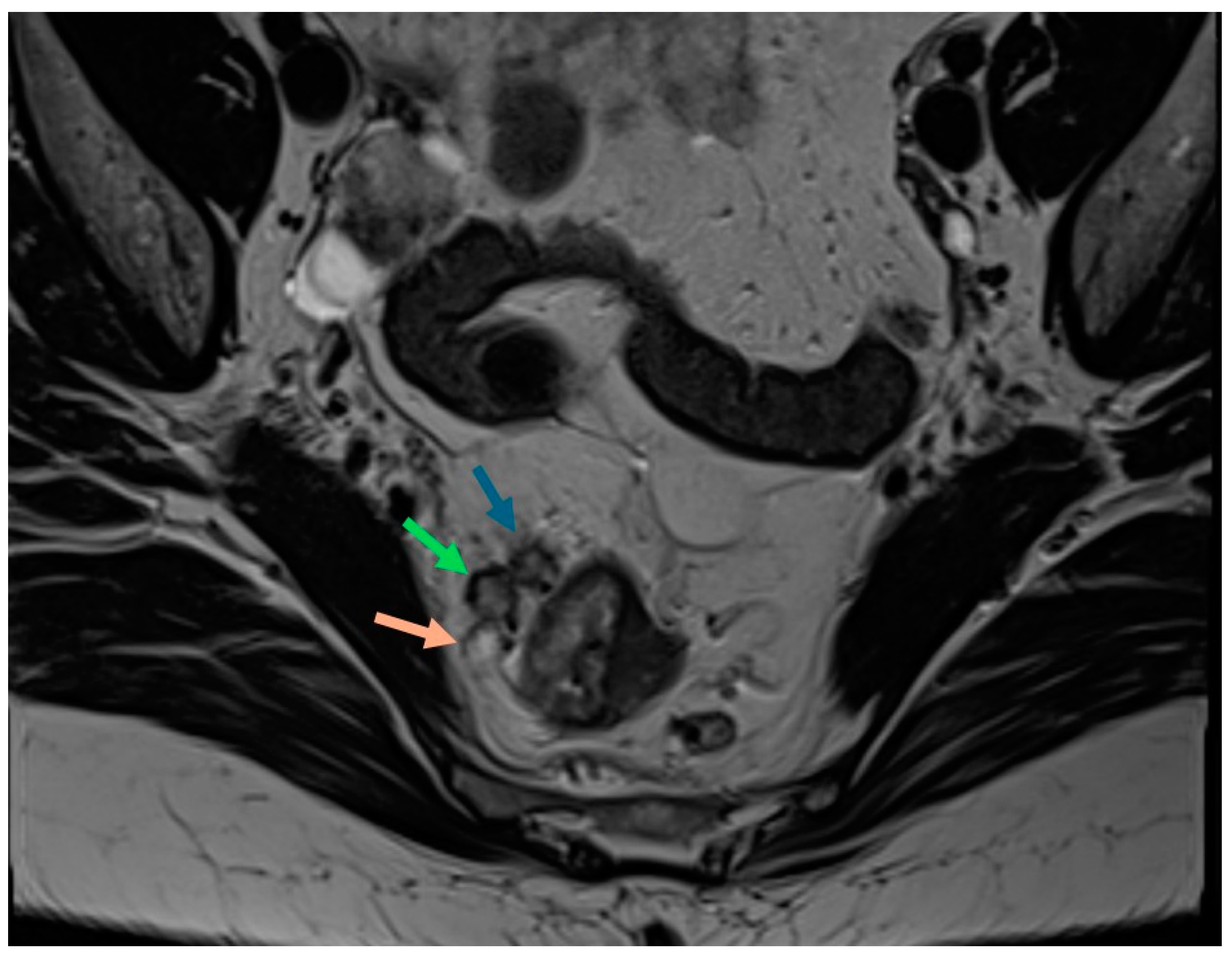 Cancers 16 03111 g003 Cancers 16 03111 g003