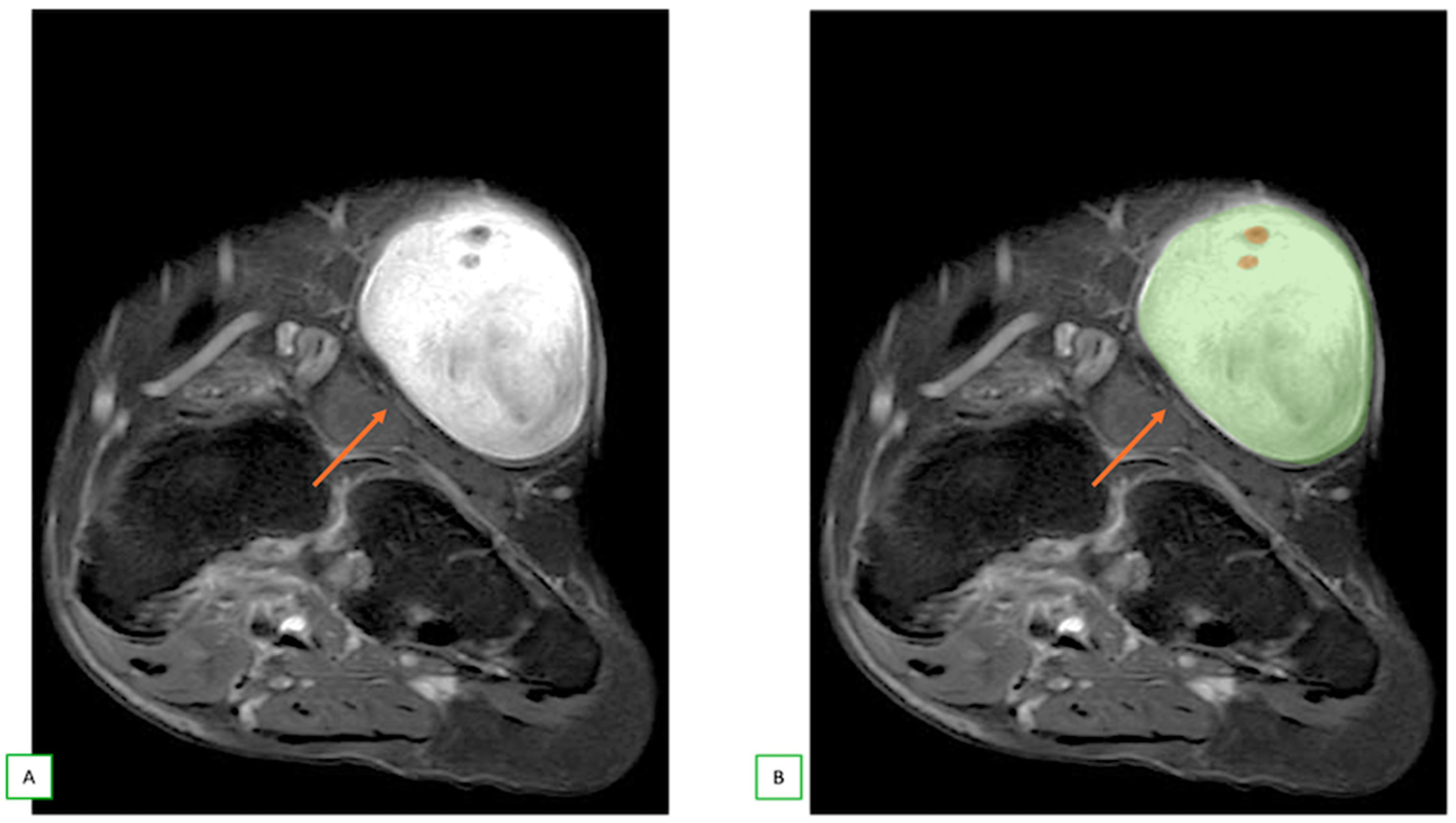 Cancers 17 00246 g006 Cancers 17 00246 g006