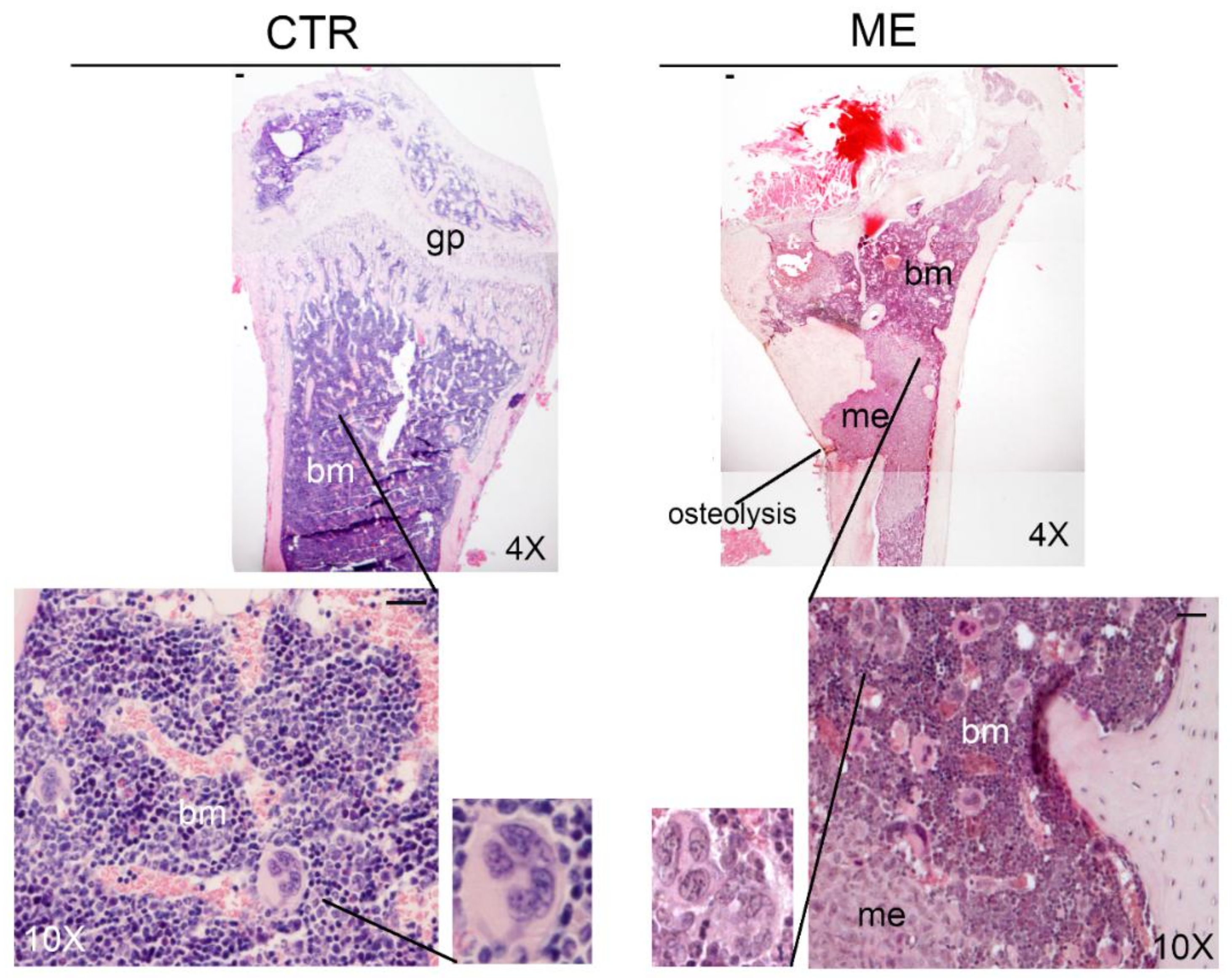 bone metastasis megakaryocytes cells