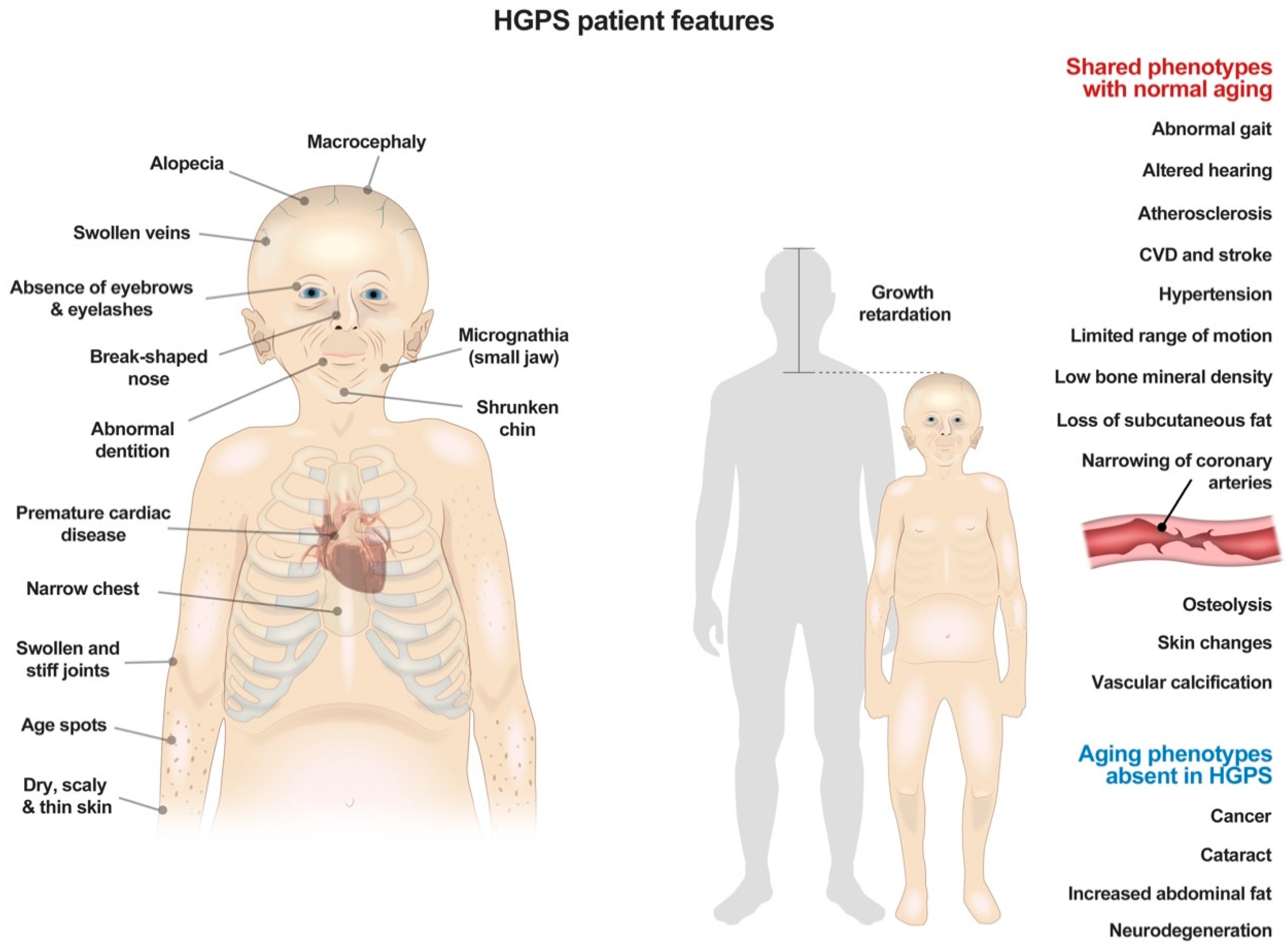 Cells Free Full Text Metabolic Dysfunction In Hutchinson Gilford Progeria Syndrome Html