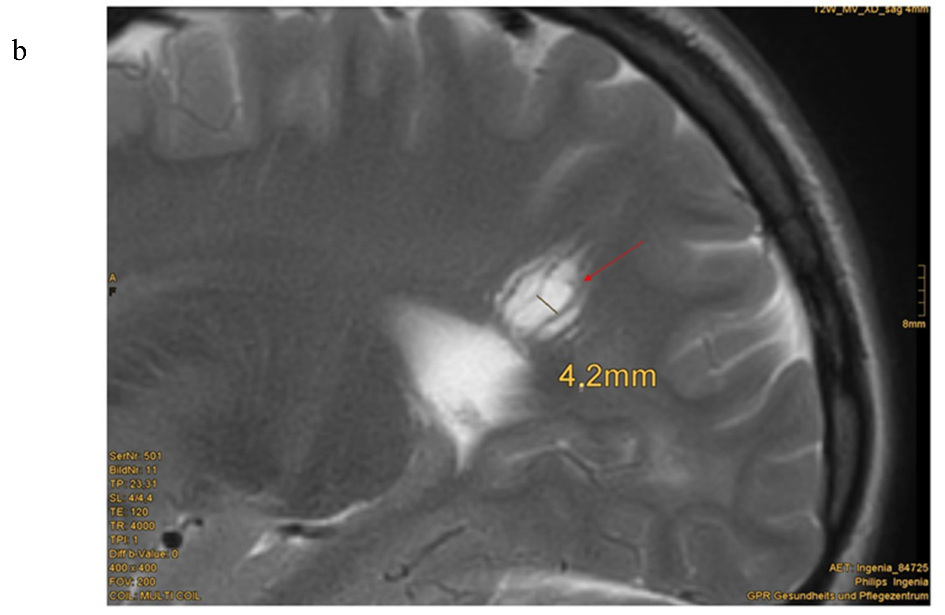 Cells | Free Full-Text | Cerebral MRI and Clinical Findings in Children  with PTEN Hamartoma Tumor Syndrome: Can Cerebral MRI Scan Help to Establish  an Earlier Diagnosis of PHTS in Children?