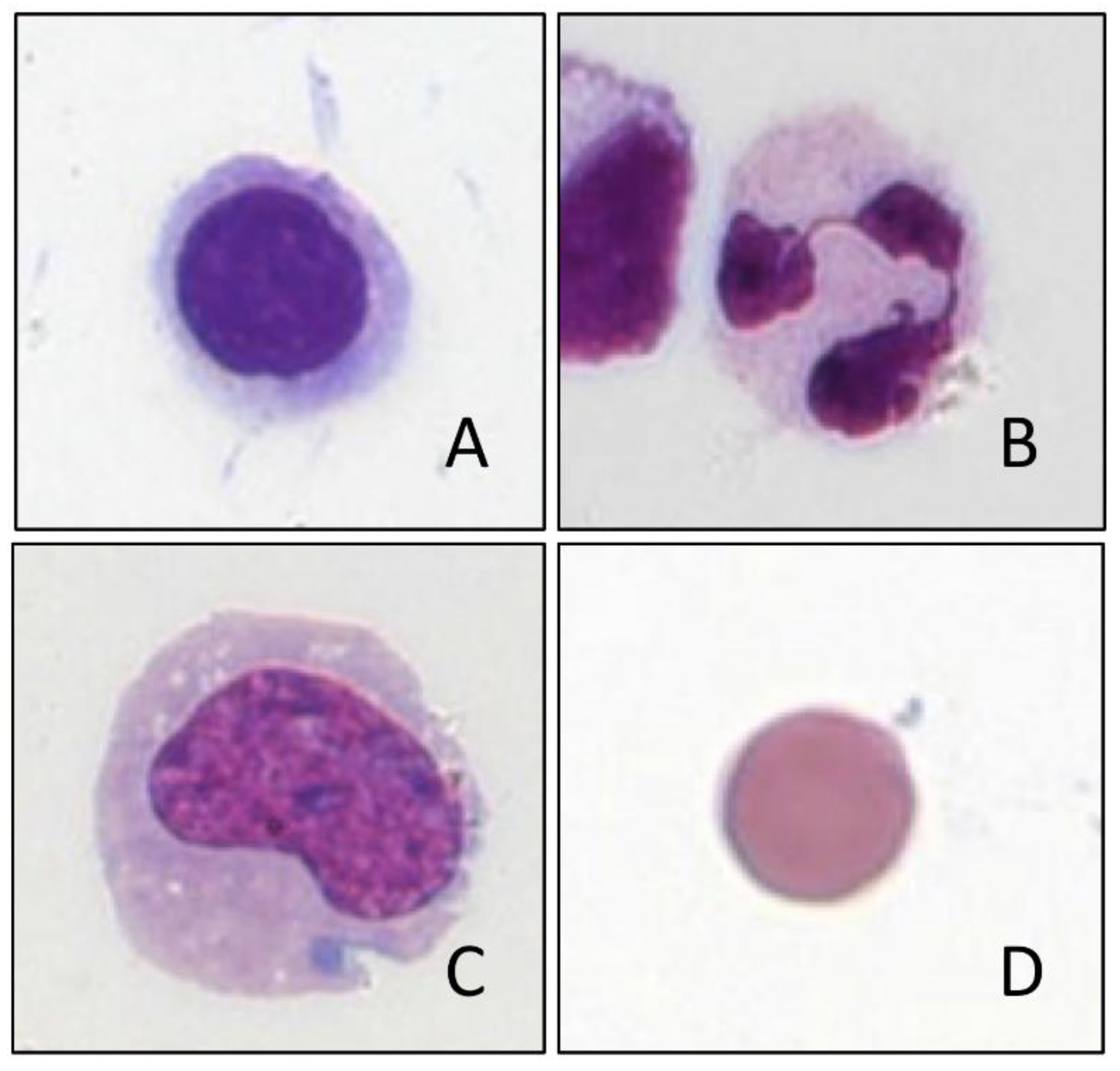 malignant cells in csf