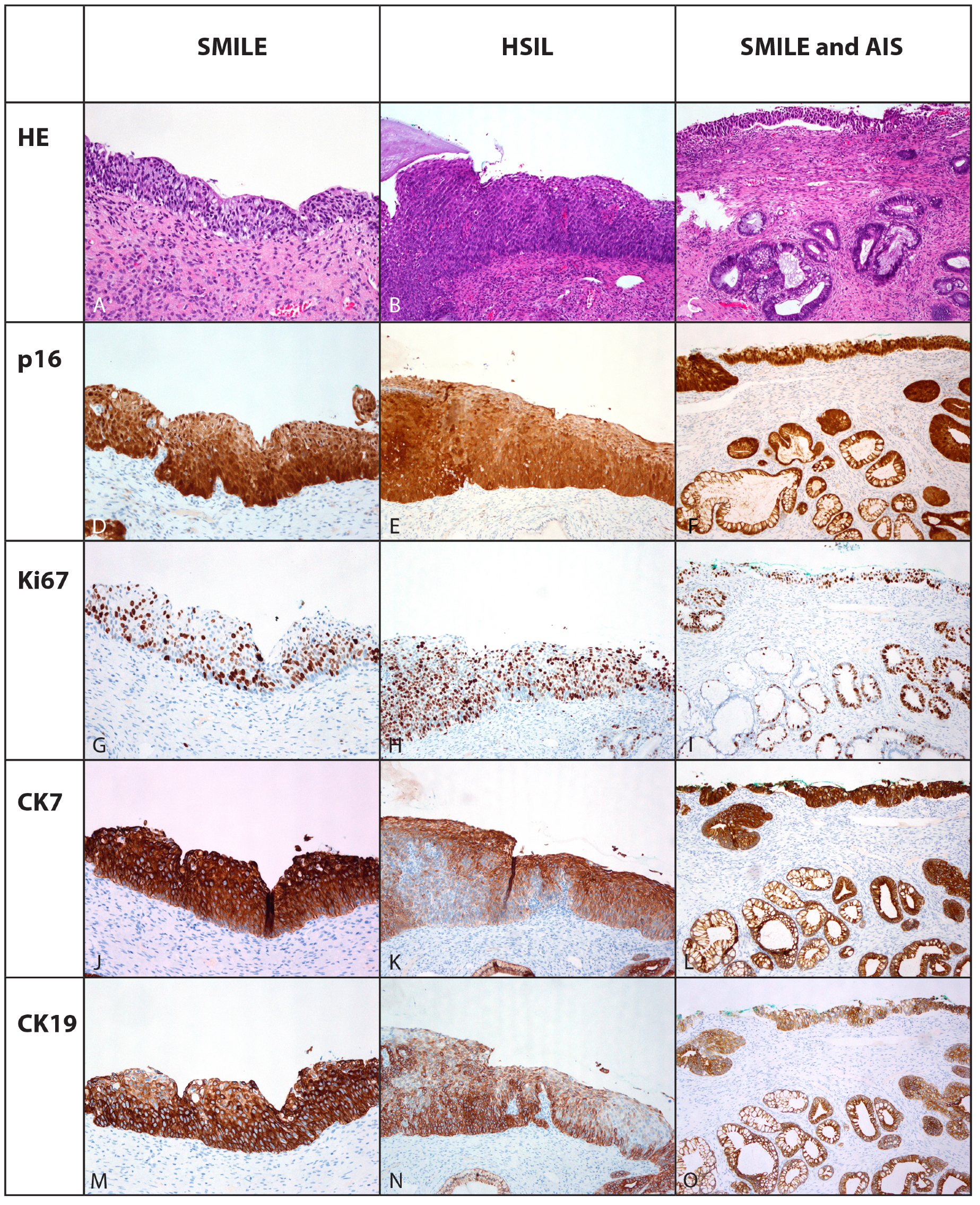 Cells | Free Full-Text | Stratified Mucin-Producing Intraepithelial Lesion  (SMILE) of the Uterine Cervix: High-Risk HPV Genotype Predominance and p40  Immunophenotype