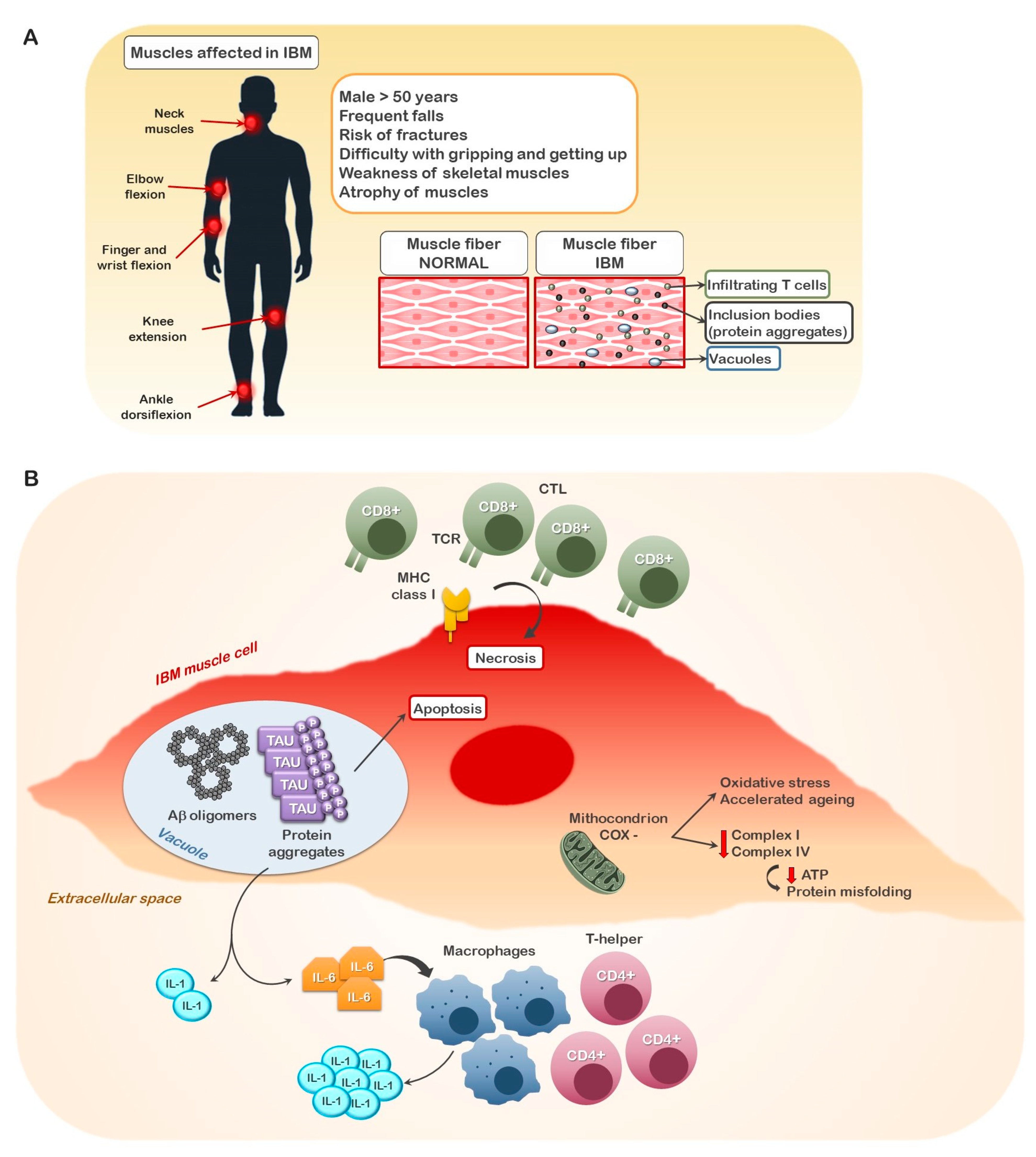Cells | Free Full-Text | Revisiting the Role of GSK3, A Modulator of Innate  Immunity, in Idiopathic Inclusion Body Myositis